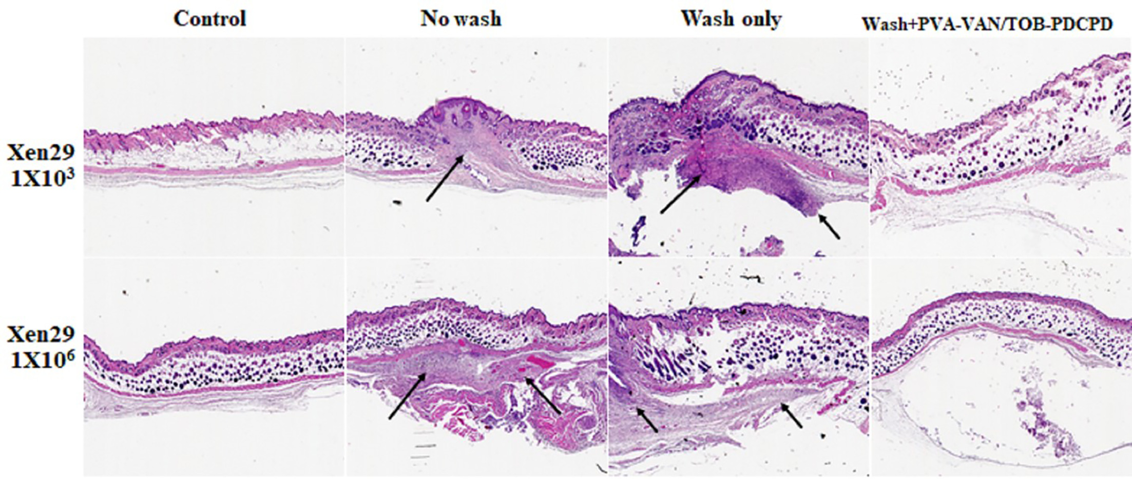 Fig. 10 
            Representative histological images of haematoxylin and eosin-stained pouch tissues dissected from mice two weeks after open pouch wash with and without vancomycin/tobramycin-doped polyvinyl alcohol composite (PVA-VAN/TOB)-polymeric dicalcium phosphate dehydrate composite (PDCPD) gel paste implantation (magnification at ×4). Group I, control; Group II, positive control without saline wash; Group III, with saline wash only; Group IV, saline wash + PVA-VAN/TOB-PDCPD: 5% VAN-PVA gel with PDCPD particles doped with both 10% VAN and 10% TOB. Arrows indicate the tissue inflammation and infection.
          