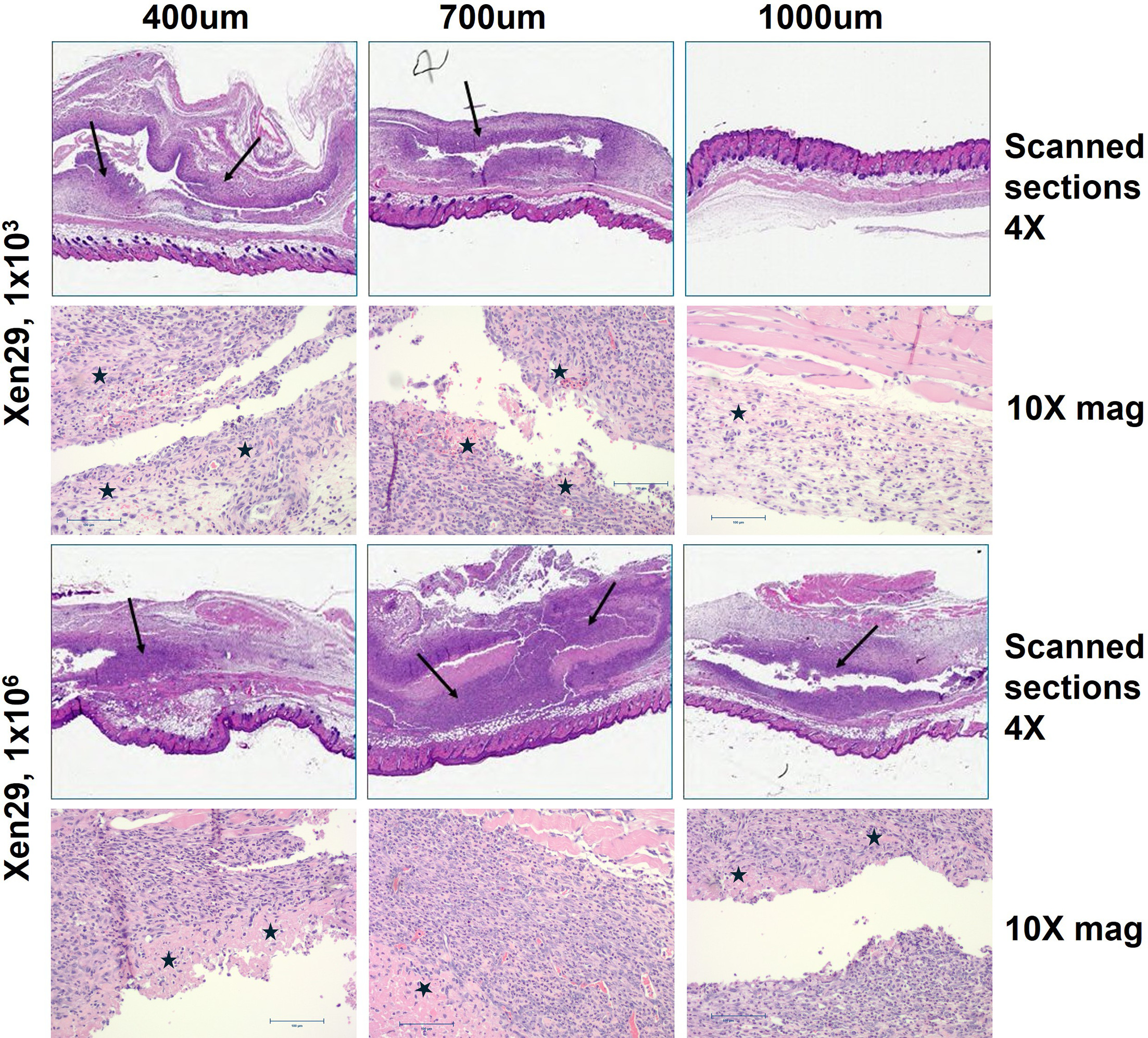 Fig. 5 
            Representative histological haematoxylin and eosin (H&E)-stained images of pouch tissues dissected from mice one week after implantation of contaminated porous titanium cylinders. The top two panels show lower (scanned sections) and higher magnification of the low-grade infection samples (103 CFU). The lower two panels show lower (scanned sections) and higher magnification of the high infection samples (106 CFU) for all pore sizes. Scale bars for all 10× magnification are 100 µm. Arrows indicate areas of infection and inflammation, and stars show areas of necrosis (from Study 1).
          