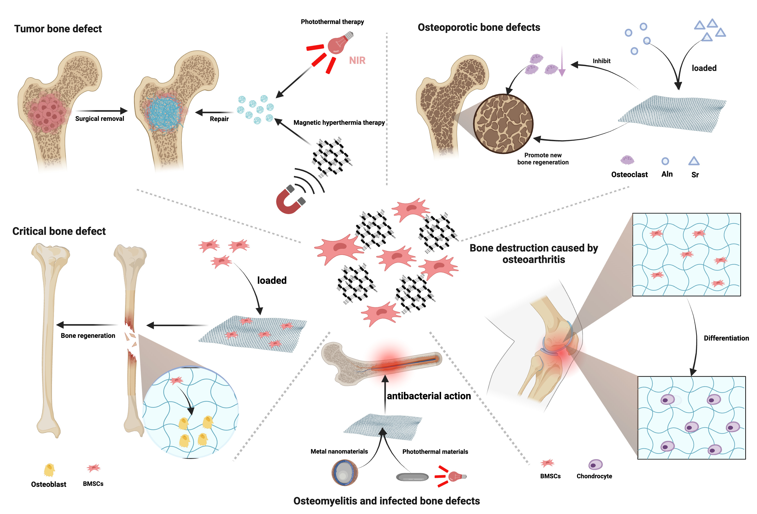 Fig. 2 
            This figure illustrates the versatile application of graphene oxide (GO)-loaded bioscaffolds in addressing various types of bone defects. Critical bone defect: reduced GO (rGO) has the capability to enhance the adhesion of bone marrow mesenchymal stem cells (BMSCs) and promote their proliferation and spontaneous osteogenic differentiation, thereby significantly accelerating the repair of bone defects. Tumour bone defect: GO scaffolds exhibit excellent photothermal and magnetic thermal properties, allowing for the targeted elimination of residual tumour cells surrounding the bone defect. Osteomyelitis and infected bone defects: GO/metal nanocomposites exhibit significant advantages in antibacterial efficacy. Additionally, GO composite materials demonstrate excellent photothermal conversion efficiency in photothermal/photodynamic therapy, leading to a powerful synergistic antibacterial phototherapeutic effect. Bone destruction caused by osteoarthritis: GO composite scaffolds are capable of promoting the proliferation and chondrogenic differentiation of BMSCs, effectively addressing bone destruction caused by osteoarthritis. Osteoporotic bone defects: GO scaffolds modified with strontium (Sr) or loaded with and releasing alendronate (Aln) effectively inhibit overactive osteoclasts in osteoporosis and promote new bone formation. NIR, near-infrared. Created with BioRender.com, and the license to publish from the BioRender has been obtained.
          