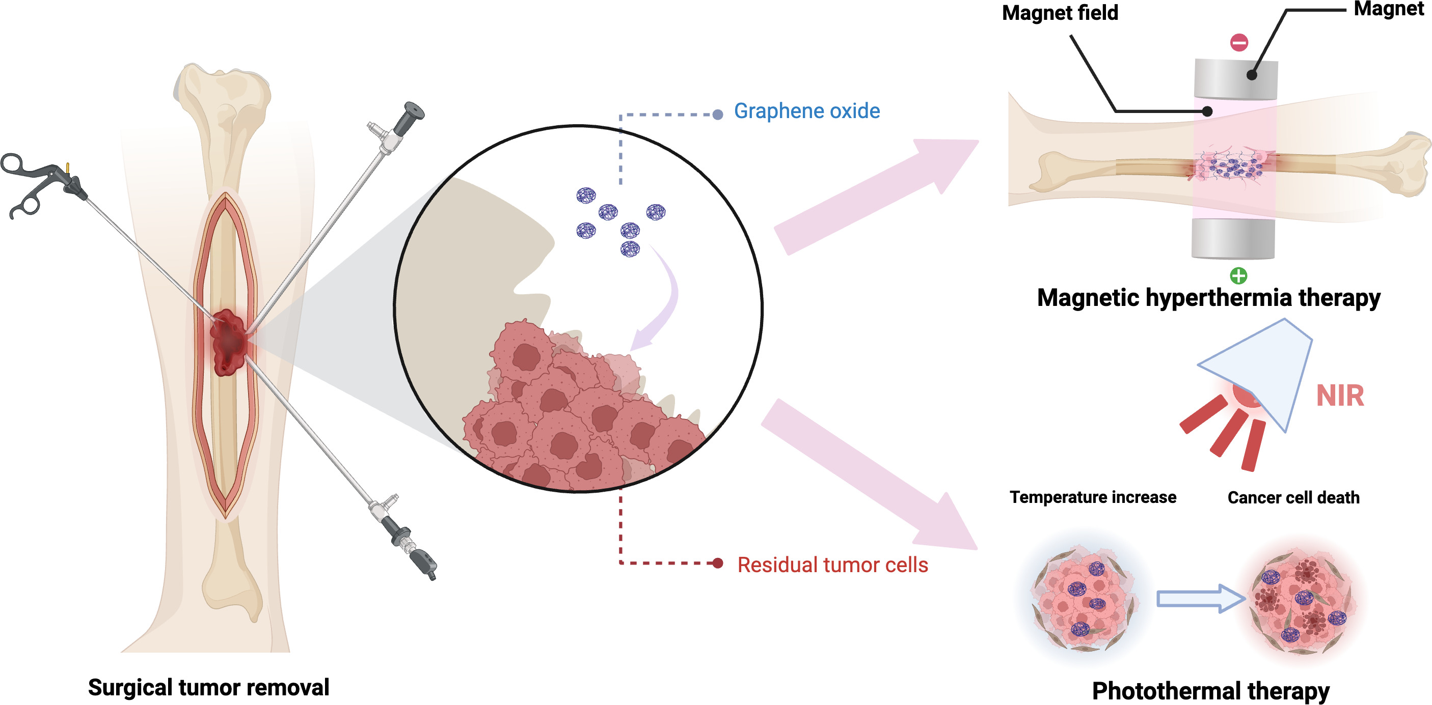 Fig. 3 
            Graphene oxide (GO) composite materials exhibit outstanding magnetic and photothermal properties. Through magnetic hyperthermia or photothermal therapy, GO composite scaffolds can effectively eliminate residual tumour cells surrounding bone defects. NIR, near-infrared. Created with BioRender.com, and the license to publish from the BioRender has been obtained.
          