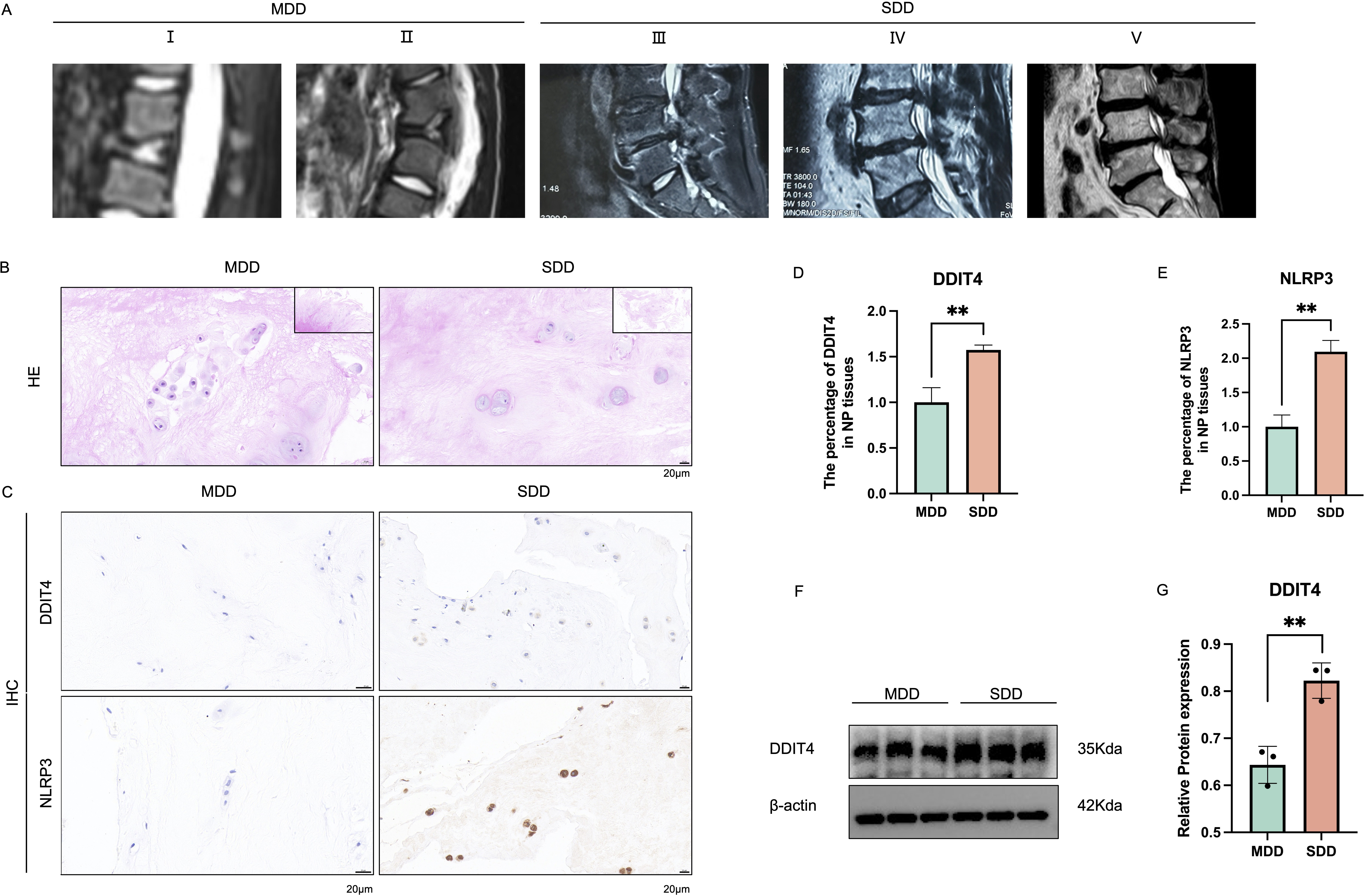 Fig. 1 
            DDIT4 expression is upregulated in the intervertebral discs of patients with intervertebral disc degeneration (IVDD) and rat models of acupuncture-induced IVDD. a) Representative MRI images of mildly degenerated discs (MDD, Pfirrmann grades I to II) and severely degenerated discs (SDD, Pfirrmann grades III to V) in human patients with IVDD. b) Haematoxylin and eosin (H&E) staining in the MDD and SDD groups (n = 6); scale bars, 20 μm. c) to e) Immunohistochemical (IHC) staining of DDIT4 and NLRP3 and quantitative analysis of positively stained cells in the tissues of the MDD and SDD groups (n = 6); scale bars, 20μm. f) and g) Western blotting and quantitative analysis of DDIT4 in the MDD and SDD groups. Scale bars in overall view: 200 μm; scale bars in local view: 20 μm. Data are expressed as the mean and standard deviation (*p < 0.05; **p < 0.01).
          