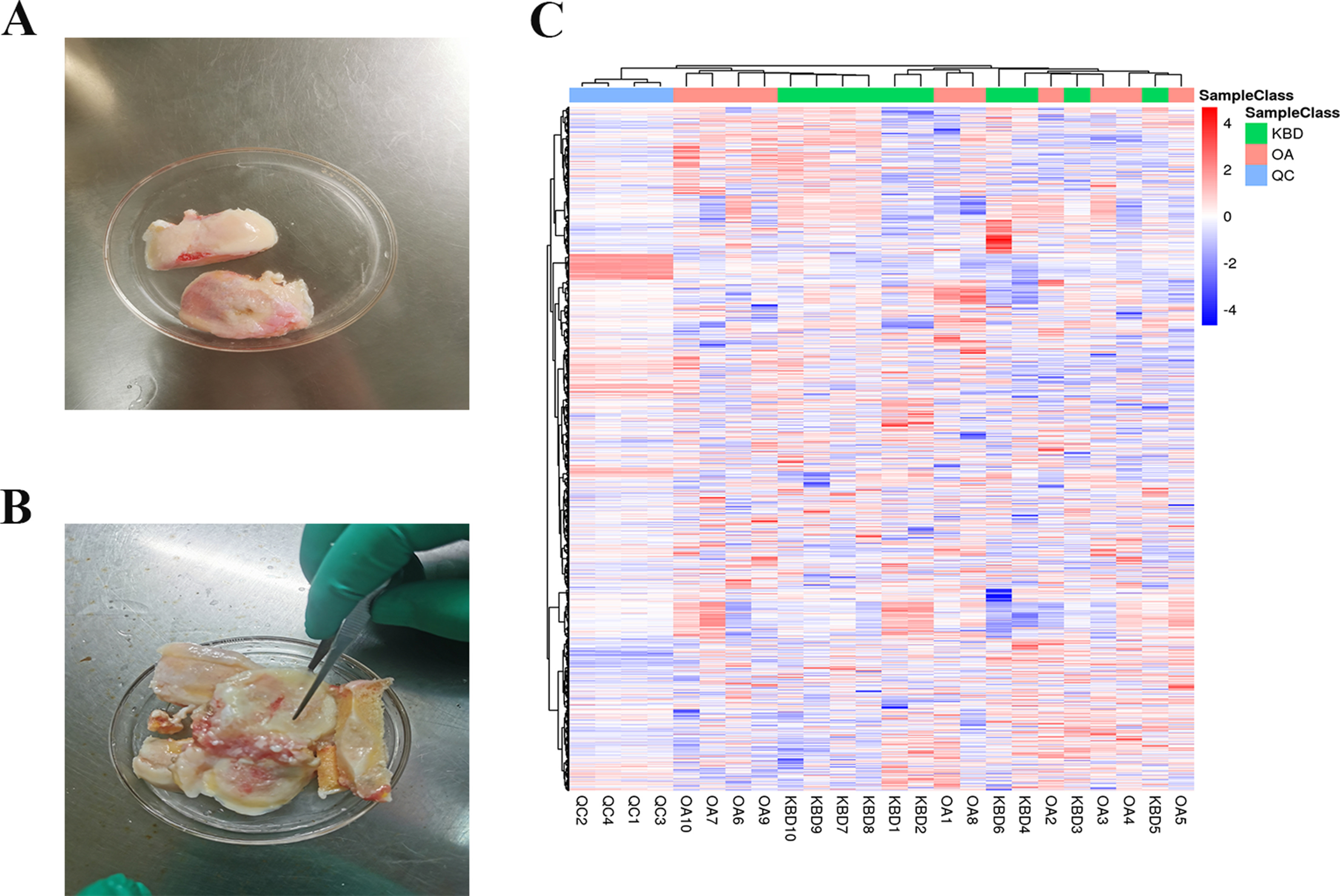 Fig. 1 
            The basic characteristics of study subjects with Kashin-Beck disease (KBD) and osteoarthritis (OA). a) and b) The cartilage specimens were derived from the patients with a) KBD and b) OA. c) The heatmap of all changed features in KBD and OA. QC, quality control.
          