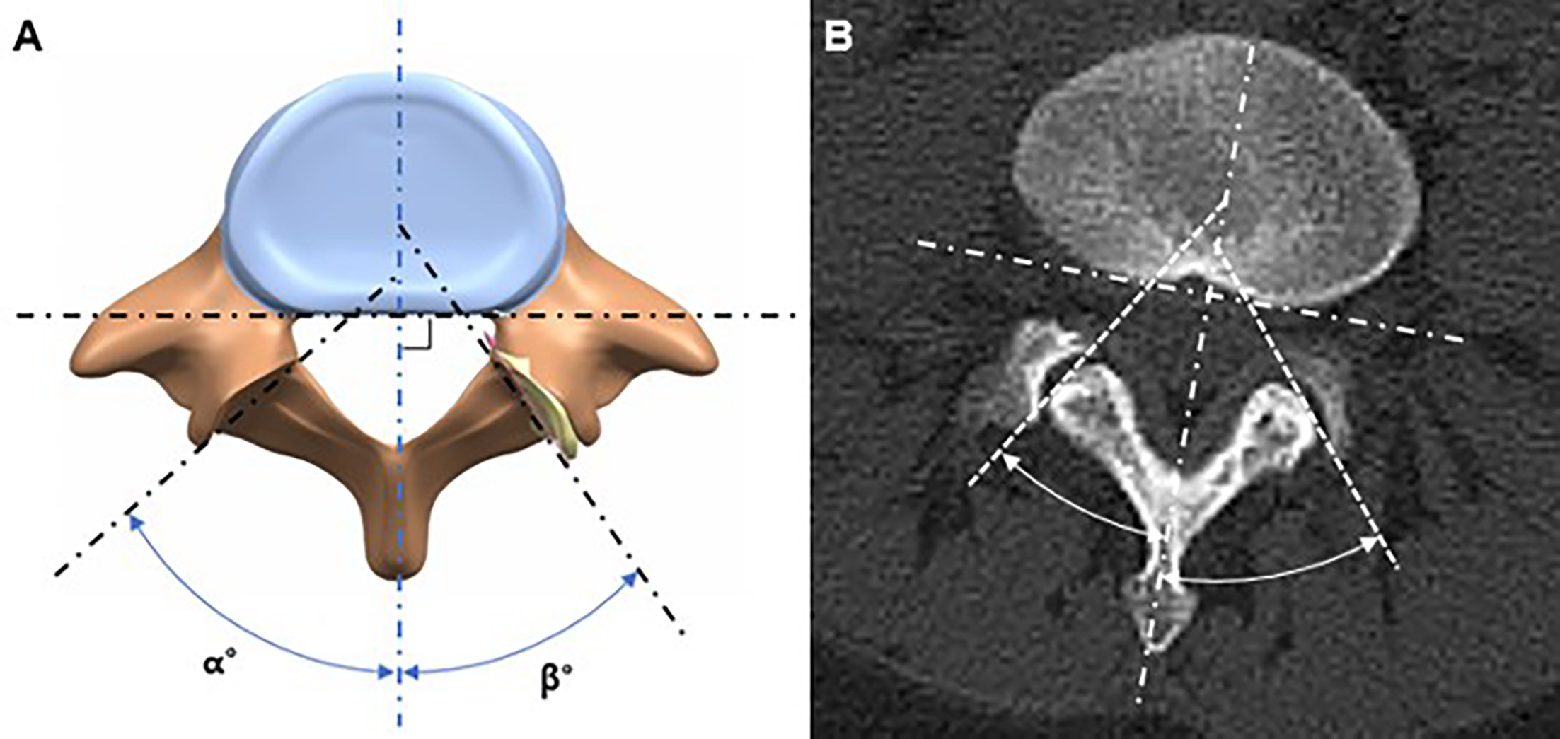 Fig. 1 
            a) Schematic diagram of facet orientation measurement. The reference plane was defined by the posterior aspect of the vertebral body. The sagittal line was drawn through the spinous process, 90° to the reference plane. The angle between the auxiliary line of the facet joint orientation and the sagittal line was measured. ‘α’ is the right facet orientation angle, and ‘β’ is the left. The smaller the angle, the more parallel the facet becomes to the sagittal plane. b) Auxiliary lines applied to the transverse image of L5/S1 level on MRI.
          