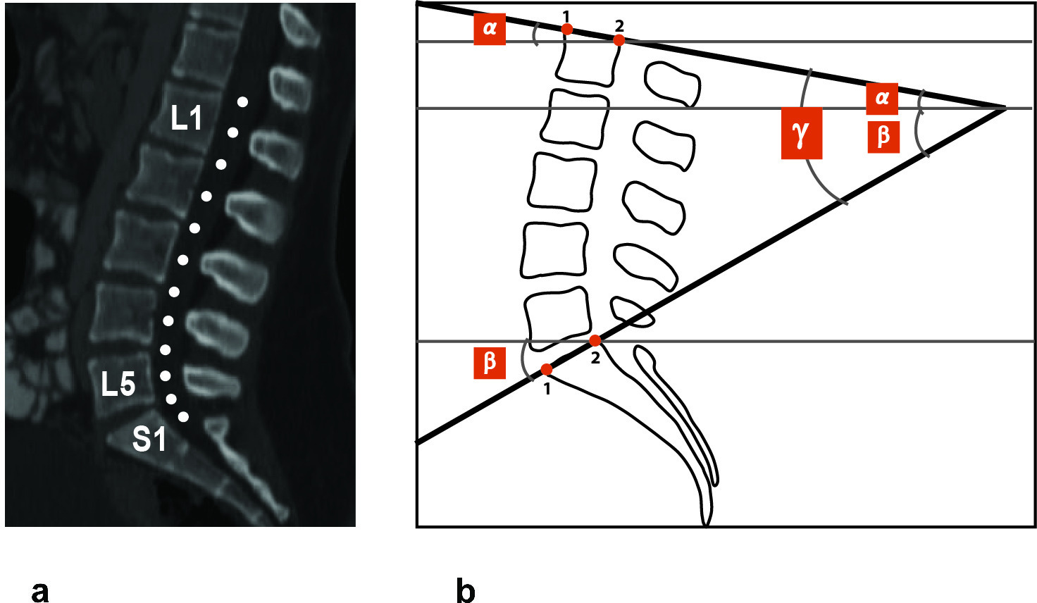 Fig. 1 
            Measurements of the lumbar curve. a) Landmarks’ position for the lumbar curve. The first landmark was placed at the level of the superior endplate of L1; the following landmarks were marked at the level of the mid-height of the vertebra (starting at L1) and mid-height of the corresponding intervertebral disc space. The last landmark was placed at the mid-height of S1. b) Angular measurements of the lumbar lordosis; the coordinates from landmarks 1 and 2 on the superior endplates of L1 and S1 were used to calculate the lumbar lordosis and sacral slope (Supplementary Table i).
          