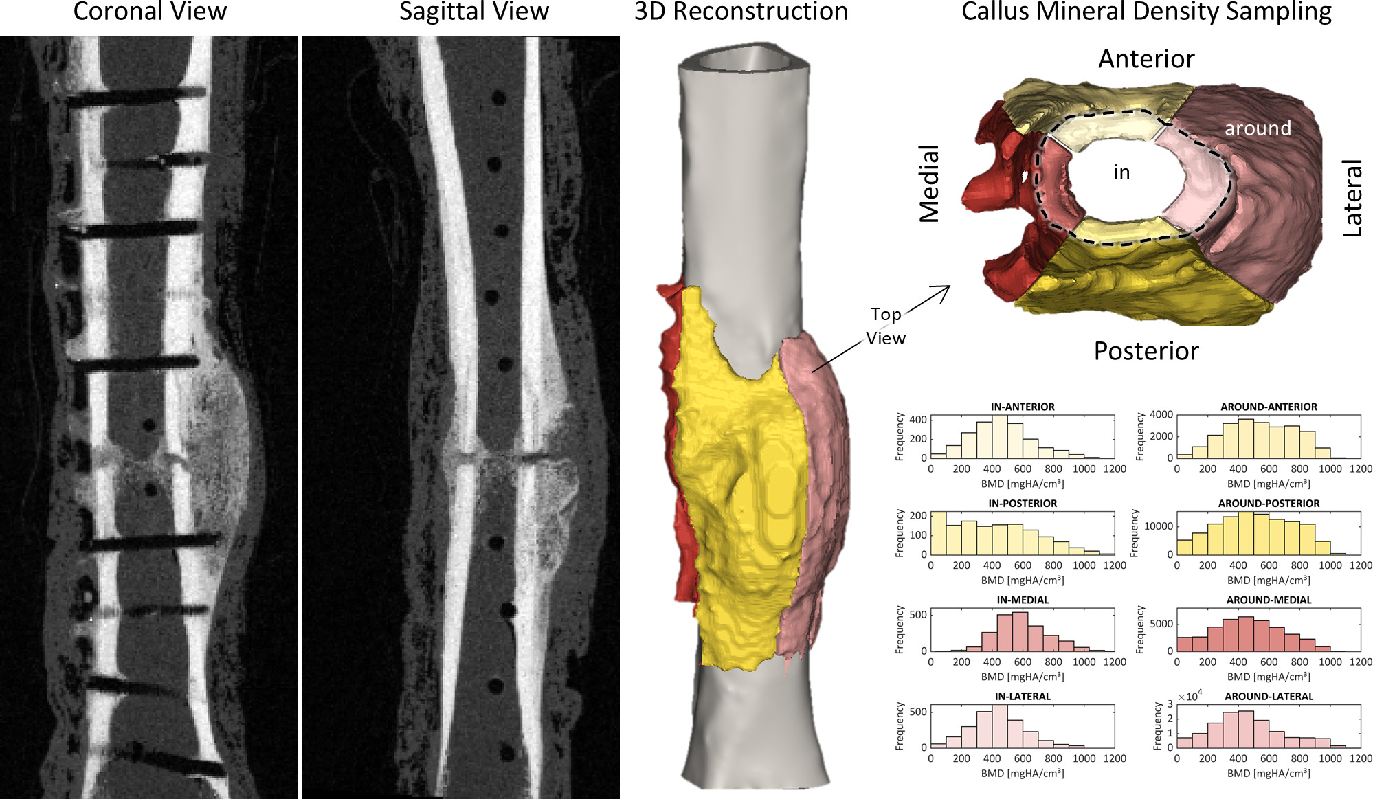 Fig. 2 
            Representative CT scan slice views and 3D reconstruction with callus masking by zone (within or around the fracture gap) and quadrant (anterior, posterior, medial, and lateral). Callus mineral density was sampled for voxels in each of the eight regions of interest.
          