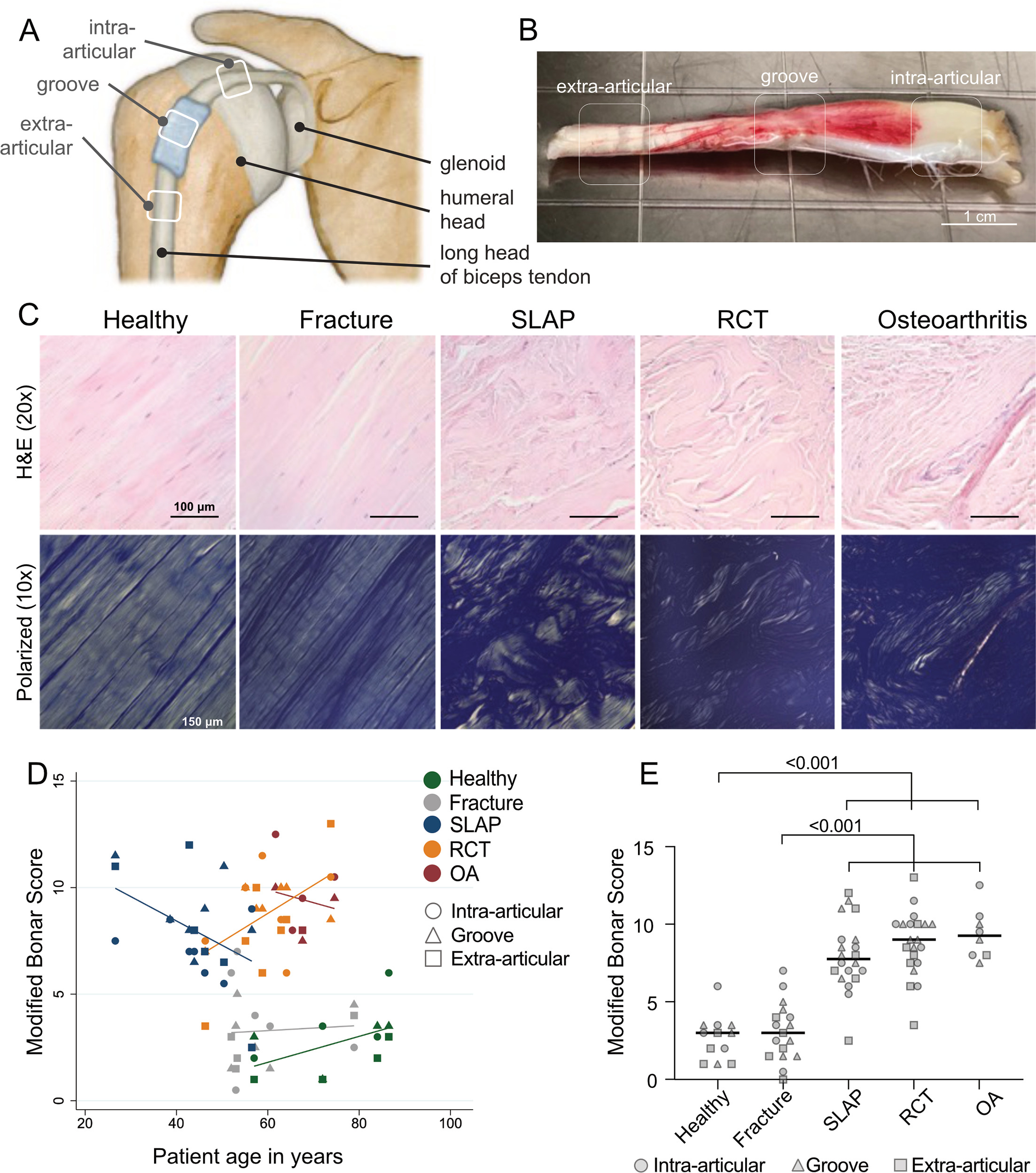 Fig. 1 
            a) Anatomical illustration of the proximal long head of biceps tendon originating from inside the shoulder joint. The three regions of interest (intra-articular, bicipital groove, extra-articular) are marked. b) Representative image of a tendon biopsy from a patient with rotator cuff tear (RCT). The increased amount of capillaries indicates ongoing inflammatory processes. The three regions of interest are indicated. Scale bar = 1 cm. c) Representative haematoxylin and eosin (H&E) stainings and polarized light microscopy images of all five patient groups. Scale bars = 100 μm for H&E images and 150 μm for polarized light microscopy images. d) Scatterplot depicting distribution of tendon degeneration (by Modified Bonar Score adapted from Fearon et al34 and Streit et al,35 see also Supplementary Table ii) with aetiology (patient group) and age. Patient groups are colour-coded, and different locations of origin are displayed by geometrical shapes (see key). Note that for each patient the assessed regions are aligned vertically due to patient age. e) Comparison of Modified Bonar scores from different shoulder tendinopathies irrespective of age. Lines represent mean scores; statistical significance was defined using linear mixed models as decribed in the Methods section. P-values are indicated if p ≤ 0.05. OA, osteoarthritis; SLAP, superior labrum anterior to posterior tear.
          