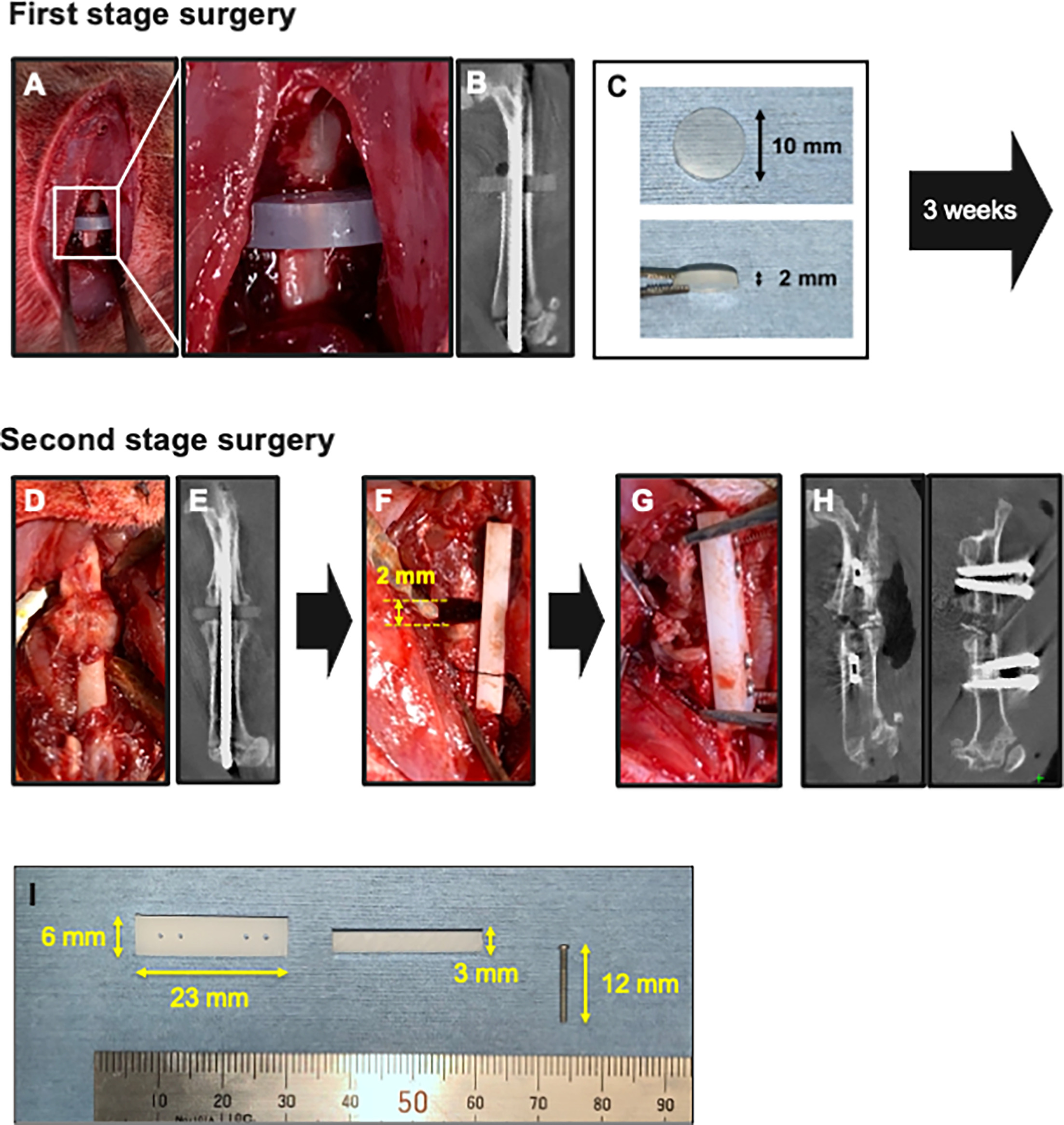 Fig. 1 
            Two-stage surgical procedures of a novel nonunion model. a) First-stage surgery. An intramedullary Kirschner wire was inserted with a silicon disc interposed at the mid-diaphysis fracture site. b) In vivo micro-CT (μCT) image of the femur immediately after the first-stage surgery. c) A silicon disc (10 mm in diameter, 2 mm thick). d) and e) Second-stage surgery. Macroscopic appearance and in vivo μCT image of the femur three weeks after the first-stage surgery. Scar tissue and callus were observed around the fracture site. f) Conversion from intramedullary fixation to plate fixation, maintaining the 2 mm defect (equivalent to the thickness of the silicon disc). g) Iliac bone grafting into the gap. h) In vivo μCT images immediately after the second-stage surgery. i) A polyoxymethylene plate (23 mm long × 6 mm wide × 3 mm high) and a stainless-steel screw (φ1.2 × 12 mm).
          