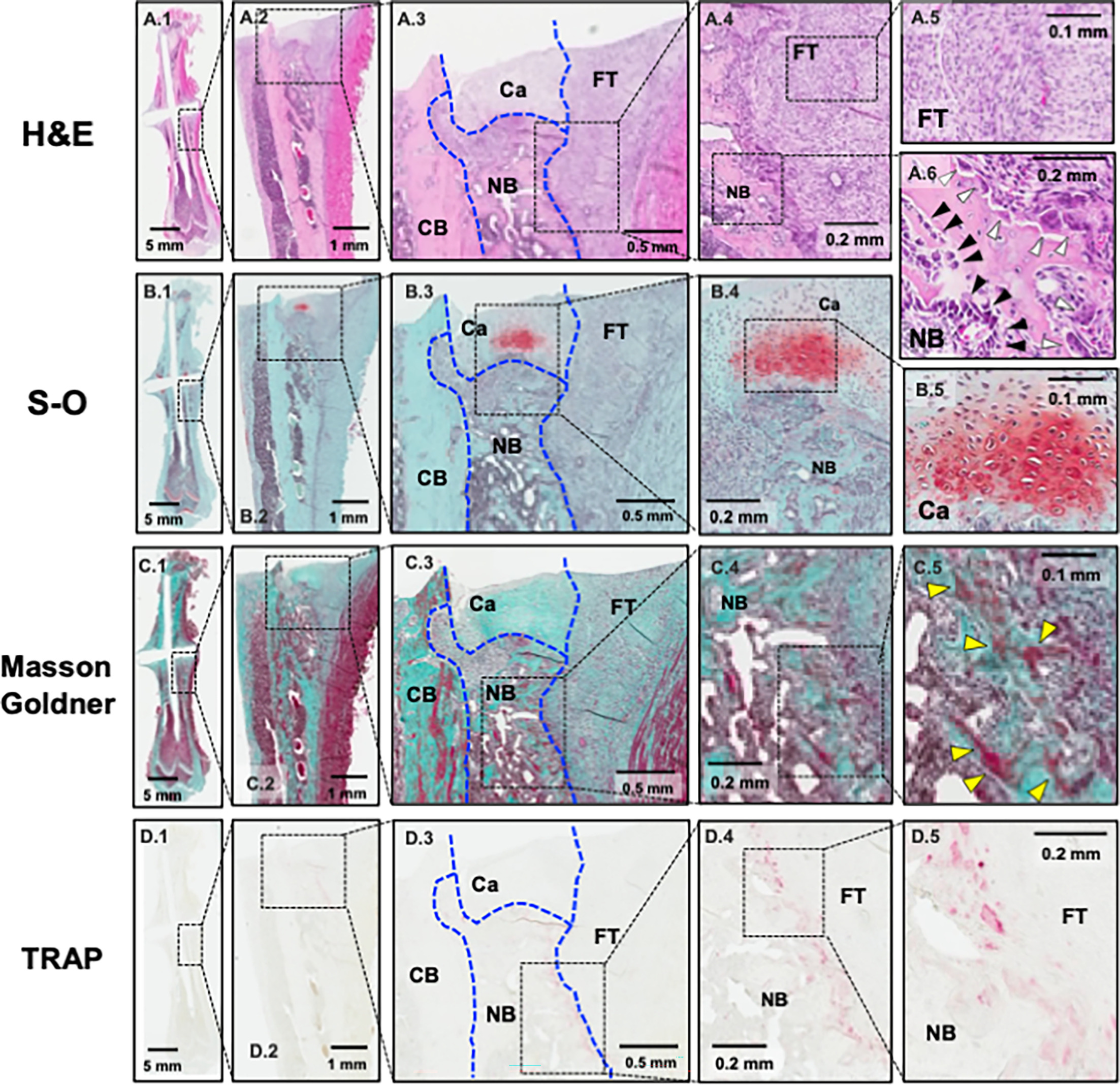 Fig. 3 
            Histological images of the femur three weeks after the first operation. a1) to a6) Haematoxylin and eosin (H&E) staining. b1) to b5) Safranin-O (S-O) staining. c1) to c5) Masson-Goldner trichrome staining. d1) to d5) Tartrate-resistant acid phosphatase (TRAP) staining. a1), b1), c1), and d1) View of the whole femur. a3, b3, c3, and d3) Newly formed woven bone, cartilaginous cover, and fibrous tissue around the cortical bone at the fracture site. a5) Spindle-shaped fibroblastic cells in fibrous tissue. a6) Aligned cuboid-shaped osteoblasts (black arrows) and multinucleated osteoclasts (white arrows) around newly formed woven bone. b5) Chondrocytes in cartilage tissue. c4) and c5) Woven bone stained red by Masson-Goldner trichrome staining (yellow arrows). d4) and d5) TRAP-positive osteoclasts observed primarily on the surface of newly formed woven bone in contact with fibrous tissue. Ca, cartilaginous cover; CB, cortical bone; FT, fibrous tissue; NB, newly formed woven bone.
          