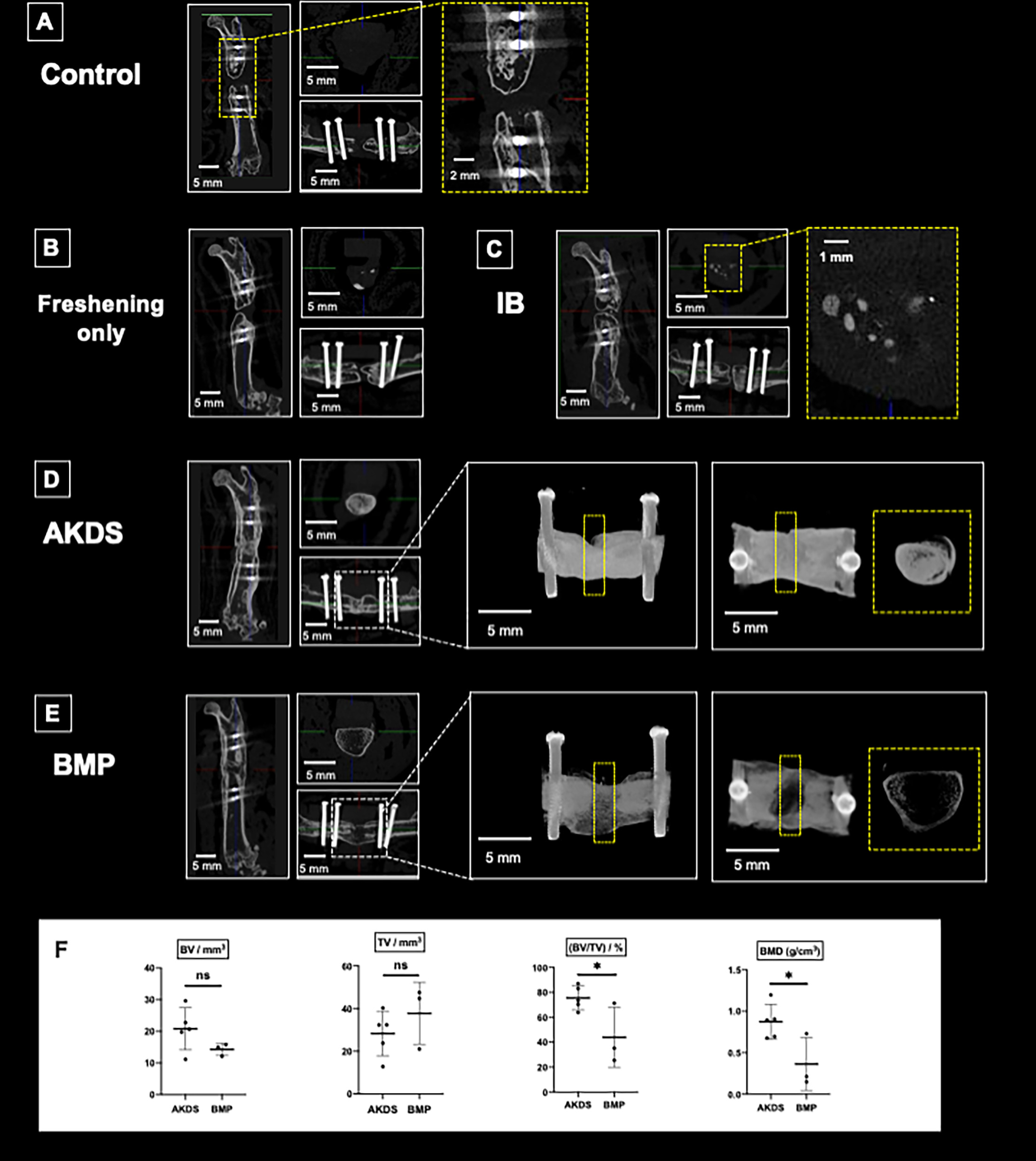 Fig. 5 
            Micro-CT analyses of the defect sites in various groups. a) Control group (no grafting nor freshening). Bone union was not achieved. Little or no new bone was observed in the defect. b) Freshening only group (no grafting after freshening of fracture ends). Bone union was not achieved. c) Iliac bone (IB) grafting group. Bone union was not achieved, and some grafted bone remained in the gap. d) AKDS group (IB grafting mixed with AKDS001-MS). Bone union was achieved with dense new bone tissue. e) BMP group (bone morphogenetic protein-2 loaded collagen sponge). Bone union was achieved with large but scant shell-like new bone. f) Bone morphometric analysis of the successfully fused samples (AKDS group, n = 5; BMP group, n = 3). *p < 0.05, all p-values calculated with independent-samples t-test. BMD, bone mineral density; BV, bone volume; ns, not significant; TV, tissue volume.
          