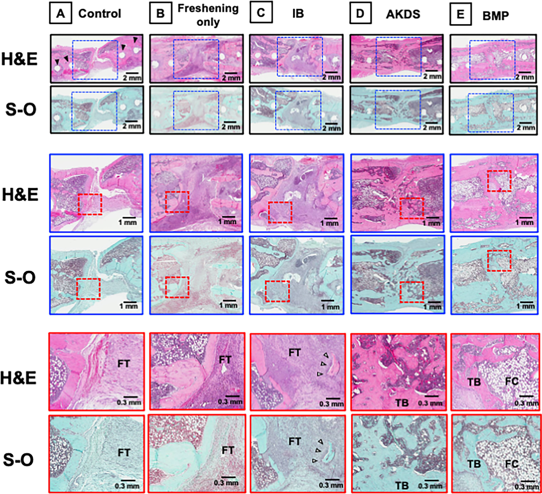 Fig. 6 
            Haematoxylin and eosin (H&E) and Safranin-O (S-O)/Fast Green staining images. a) Control group (no grafting). The defect was filled with fibrous tissue (FT). Black arrows indicate screw holes. b) Freshening only group. The defect was filled with FT and minimal new bone. c) Iliac bone (IB) group. The defect was filled with FT and some residual grafted bone (white arrow). d) AKDS group (IB grafting mixed with AKDS001-MS). New bone with a dense trabecular bone (TB) structure was formed. e) Bone morphogenetic protein (BMP) group (BMP-2 loaded collagen sponge). New bone with abundant fatty cells (FC) was formed.
          