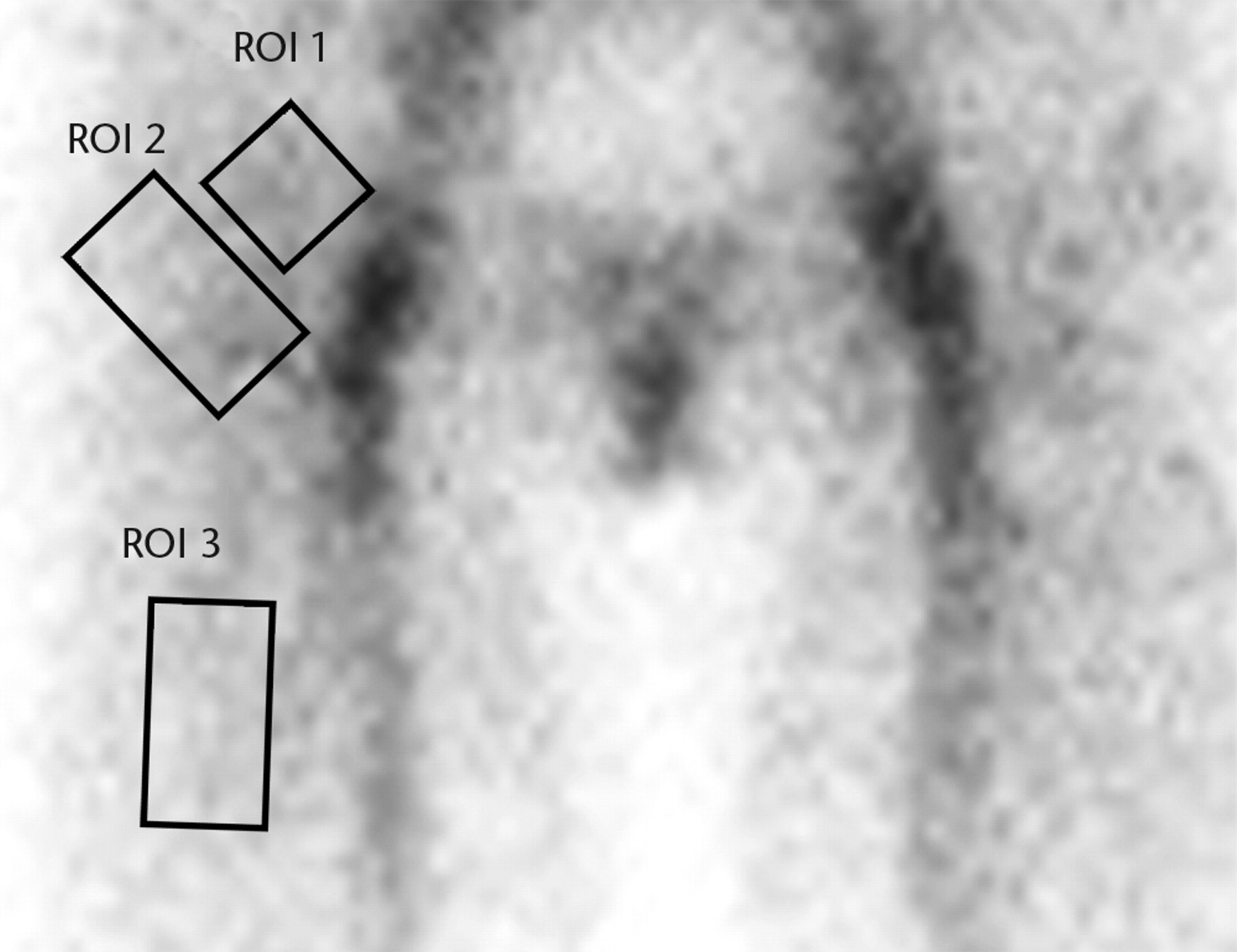 Figs. 1a - 1b 
            Planar images showing the three
regions of interest (ROIs) in a) the early (vascular) phase and
b) the late phase.
          