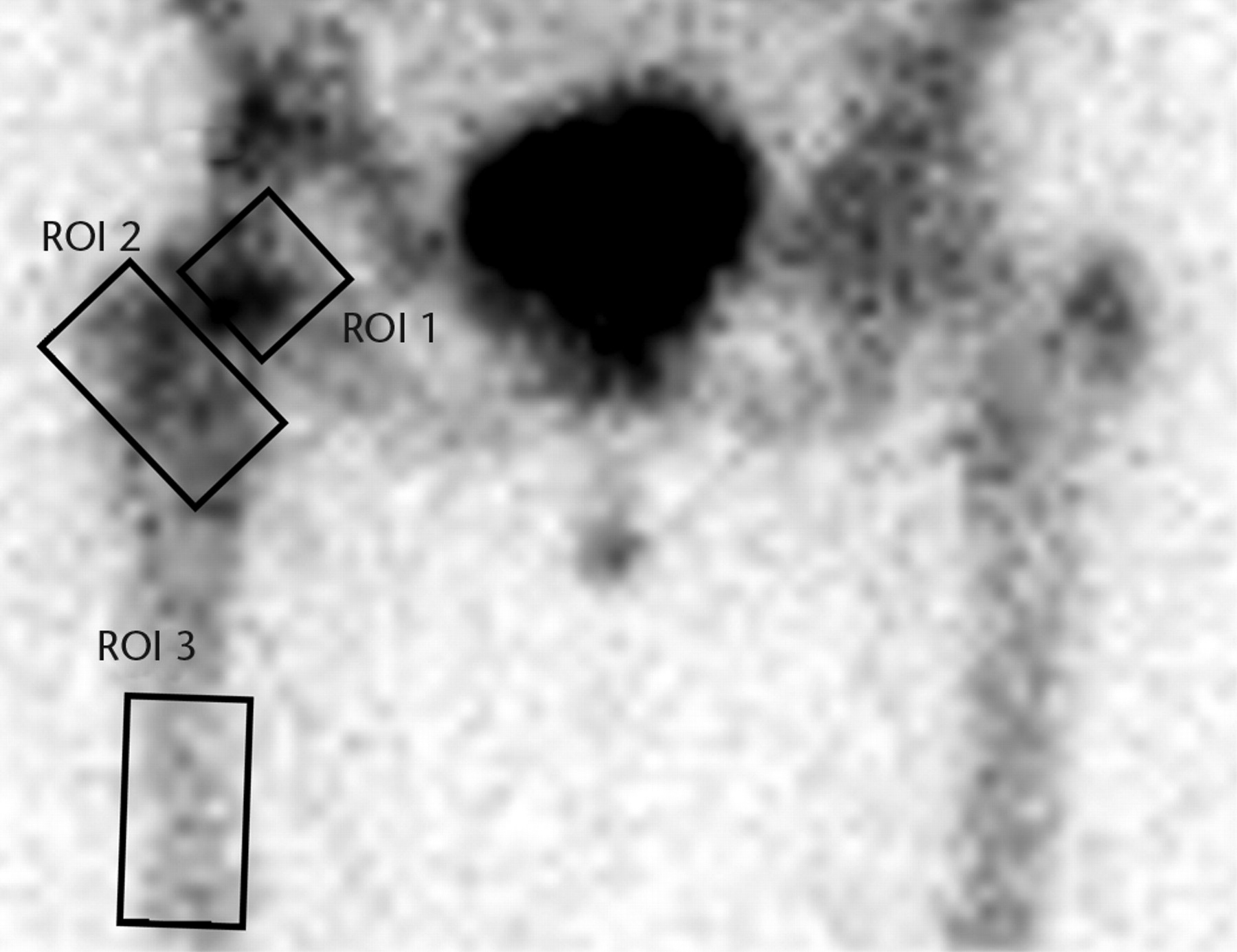 Figs. 1a - 1b 
            Planar images showing the three
regions of interest (ROIs) in a) the early (vascular) phase and
b) the late phase.
          