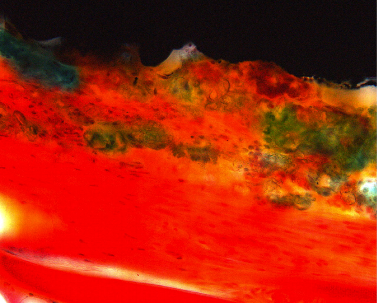 Fig. 1 
            Light micrograph (primary magnification
×40) of implant with porous coating and plasma sprayed hydroxyapatite
(PC + HA). Hydroxyapatite is stained green, however the coating
is easy to distinguish from bone by its irregular structure. Titanium
is seen as black in the top.
          