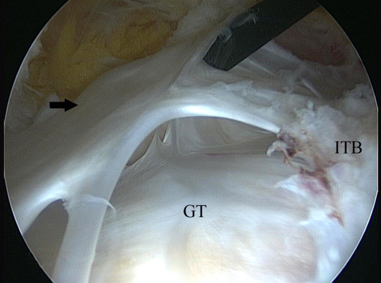 Figs. 11a - 11c 
          Arthroscopic images of the
left hip of a 64-year-old woman with persistent pain following arthroscopic
release of the iliotibial band (ITB) and excision of the trochanteric
bursa. A revision endoscopy (a) revealed that the ITB flaps had
healed back together. Upon opening of the ITB, significant adhesions (arrow)
were found to have formed in the lateral compartment (b), tethering
the ITB to the greater trochanter. After adhesiolysis and release
of the ITB as distal as the origin of the vastus lateralis (c),
there were marked improvements in symptoms, and the procedure was
repeated on the right hip after seven months, with similar success
(SF, subcutaneous fat; GT, greater trochanter; VL, vastus lateralis;
aITB/pITB, anterior/posterior flap of the iliotibial band).
        