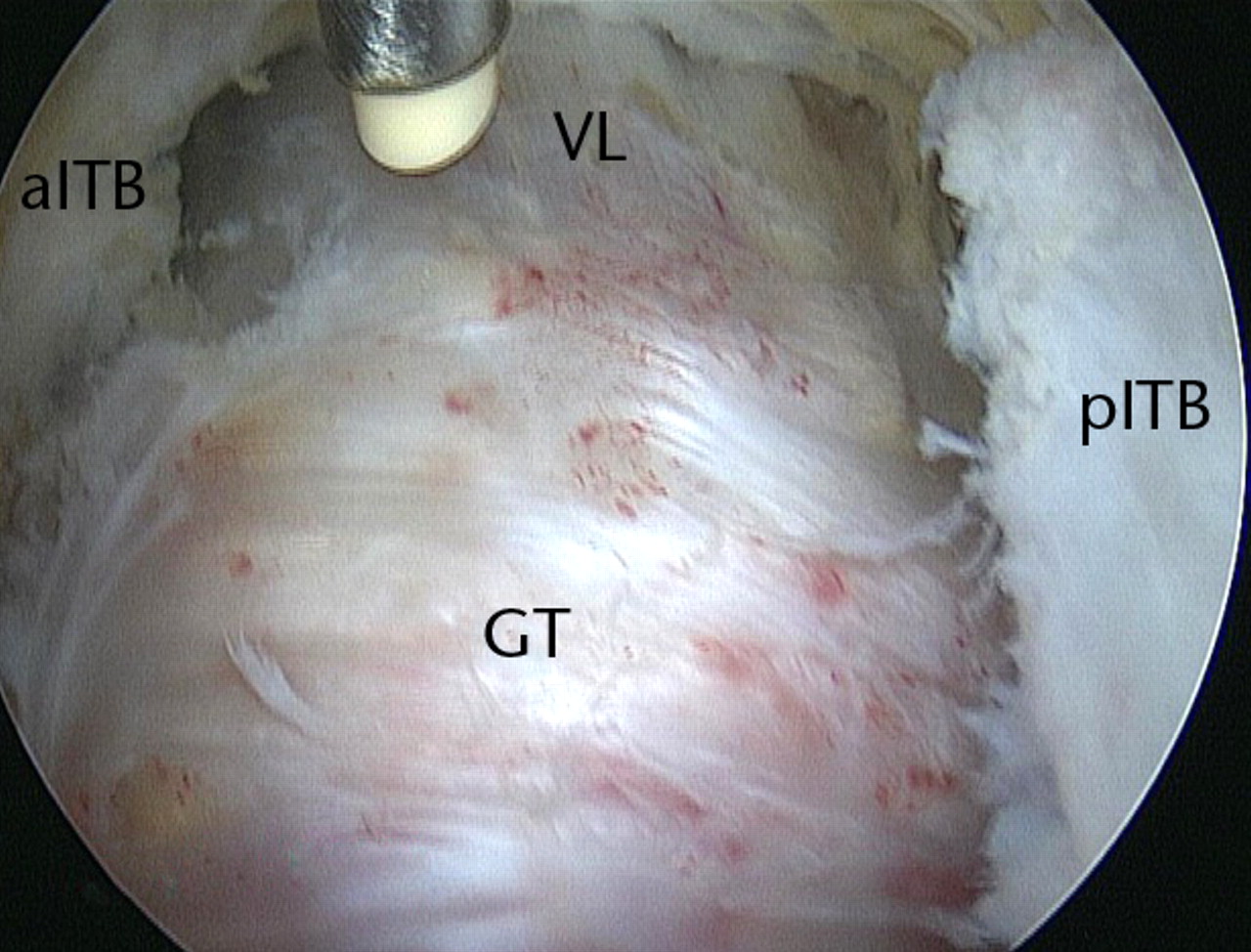 Figs. 11a - 11c 
          Arthroscopic images of the
left hip of a 64-year-old woman with persistent pain following arthroscopic
release of the iliotibial band (ITB) and excision of the trochanteric
bursa. A revision endoscopy (a) revealed that the ITB flaps had
healed back together. Upon opening of the ITB, significant adhesions (arrow)
were found to have formed in the lateral compartment (b), tethering
the ITB to the greater trochanter. After adhesiolysis and release
of the ITB as distal as the origin of the vastus lateralis (c),
there were marked improvements in symptoms, and the procedure was
repeated on the right hip after seven months, with similar success
(SF, subcutaneous fat; GT, greater trochanter; VL, vastus lateralis;
aITB/pITB, anterior/posterior flap of the iliotibial band).
        