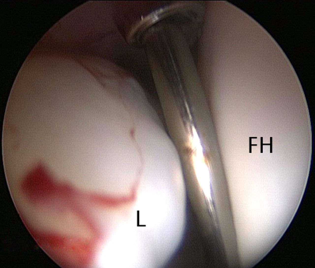 Figs. 2a - 2d 
          Arthroscopic images of the
right hip of a 53-year-old woman with mild dysplasia, showing a)
significant hypertrophy of the anterosuperior labrum, leaving little
room for the 5 mm dilator and guide wire inserted through the anterior
portal, b) the radiofrequency ablation probe just interposed safely
between the labrum and the femoral head, c) partial labral detachment
(arrow), and d) improved visualisation after labral repair with
a suture anchor (arrow) (L, labrum; FH, femoral head; Ac, acetabulum).
        