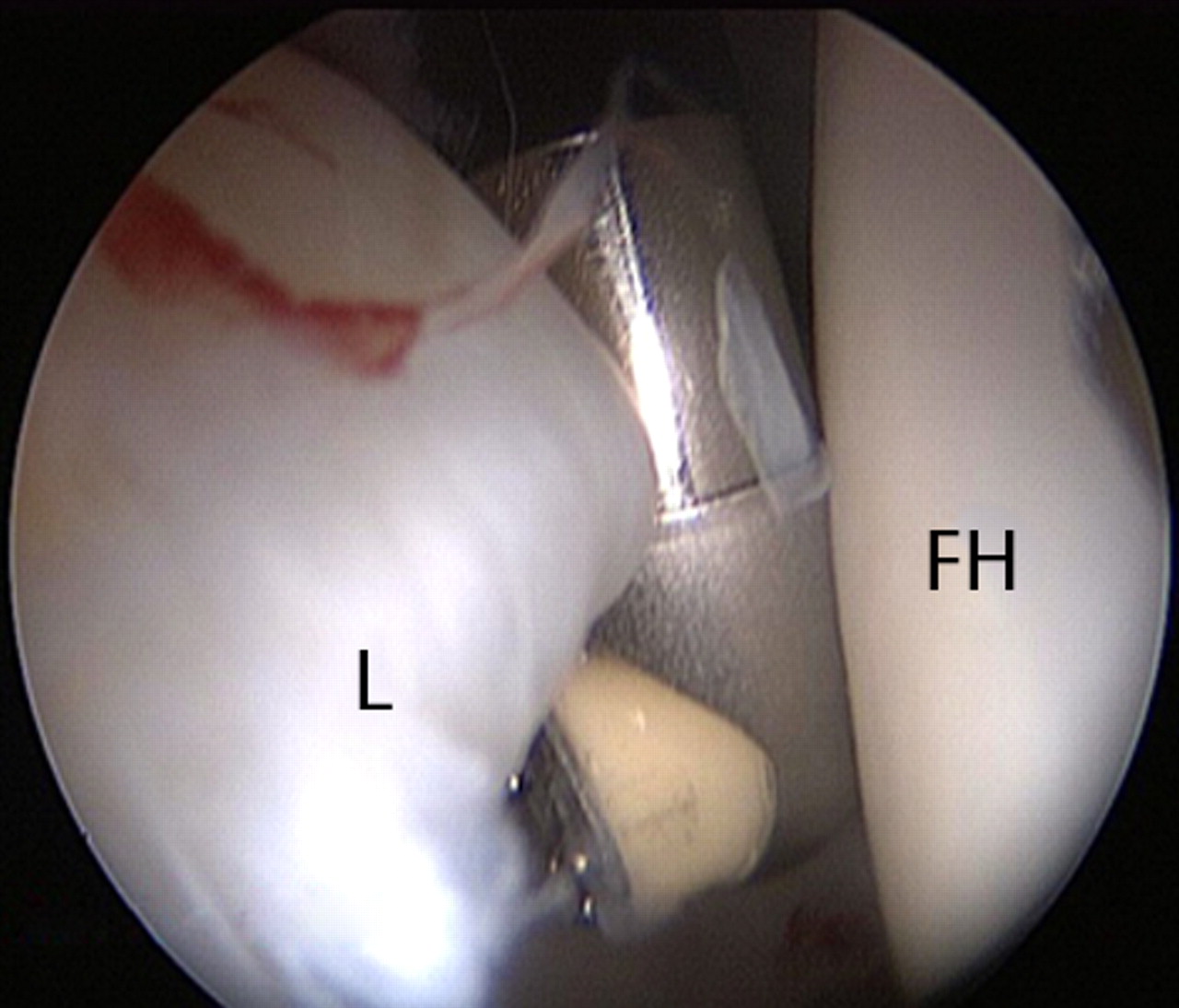 Figs. 2a - 2d 
          Arthroscopic images of the
right hip of a 53-year-old woman with mild dysplasia, showing a)
significant hypertrophy of the anterosuperior labrum, leaving little
room for the 5 mm dilator and guide wire inserted through the anterior
portal, b) the radiofrequency ablation probe just interposed safely
between the labrum and the femoral head, c) partial labral detachment
(arrow), and d) improved visualisation after labral repair with
a suture anchor (arrow) (L, labrum; FH, femoral head; Ac, acetabulum).
        