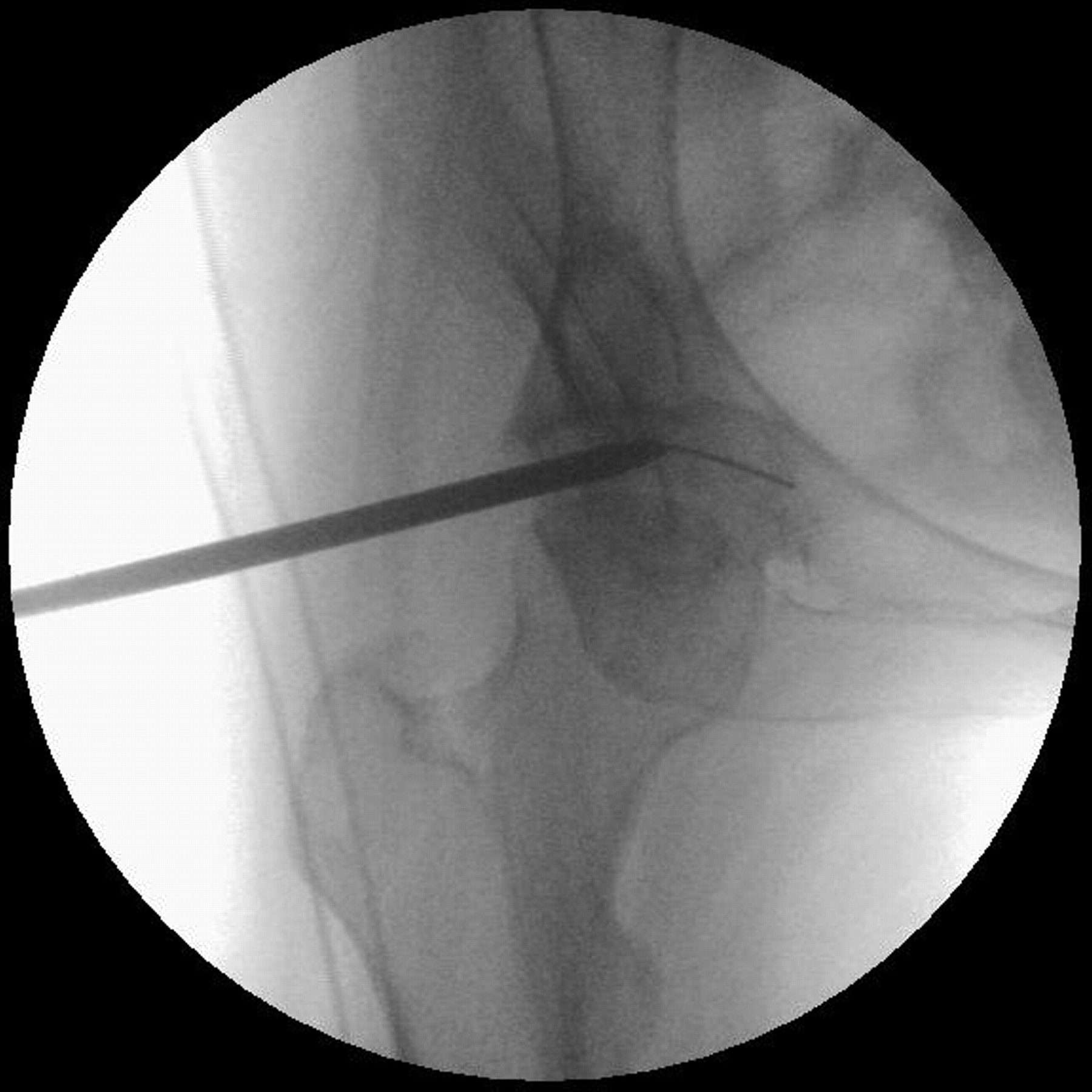 Figs. 4a - 4c 
          Image intensifier (a) and arthroscopic
(b) images showing the insertion of a cannulated 4.5 mm trocar over
a bottomed out nitinol guide wire, and c) a bent nitinol guide wire
inserted into the peripheral compartment and past the medial capsule
of the hip. A broken guide wire in that area is difficult to retrieve.
        