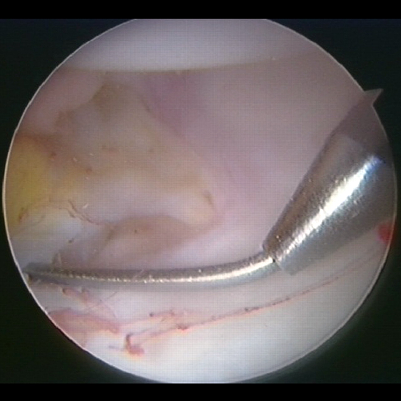 Figs. 4a - 4c 
          Image intensifier (a) and arthroscopic
(b) images showing the insertion of a cannulated 4.5 mm trocar over
a bottomed out nitinol guide wire, and c) a bent nitinol guide wire
inserted into the peripheral compartment and past the medial capsule
of the hip. A broken guide wire in that area is difficult to retrieve.
        