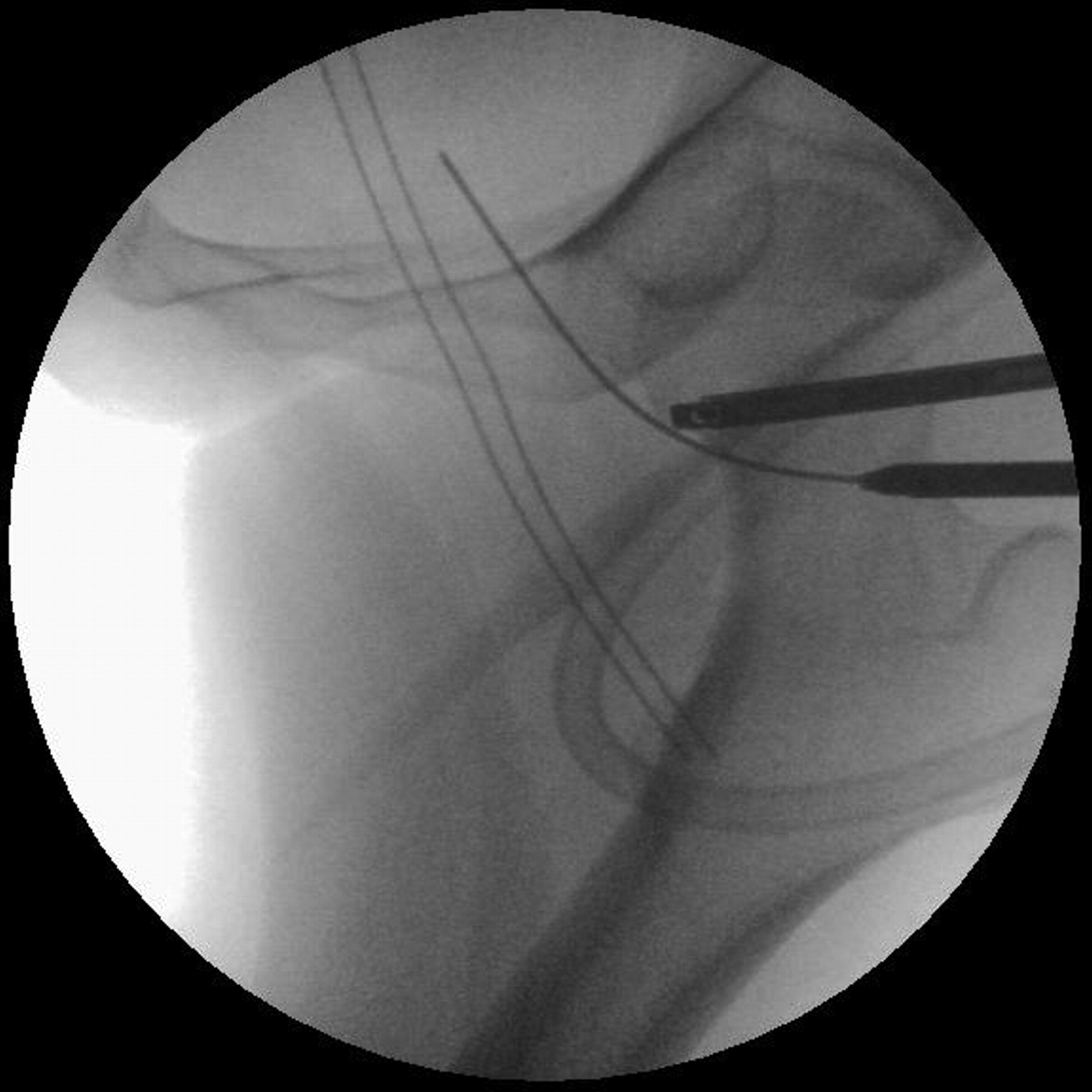 Figs. 4a - 4c 
          Image intensifier (a) and arthroscopic
(b) images showing the insertion of a cannulated 4.5 mm trocar over
a bottomed out nitinol guide wire, and c) a bent nitinol guide wire
inserted into the peripheral compartment and past the medial capsule
of the hip. A broken guide wire in that area is difficult to retrieve.
        