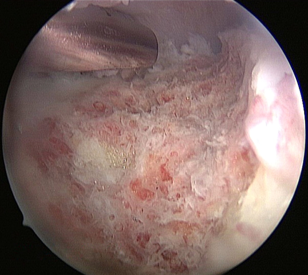 Figs. 6a - 6b 
            Arthroscopic images of the peripheral
compartment of a left hip, a) after femoral osteochondroplasty,
showing the exposed bleeding surface of raw cancellous bone, and
b) after treatment with the radiofrequency ablation probe for haemostasis.
          