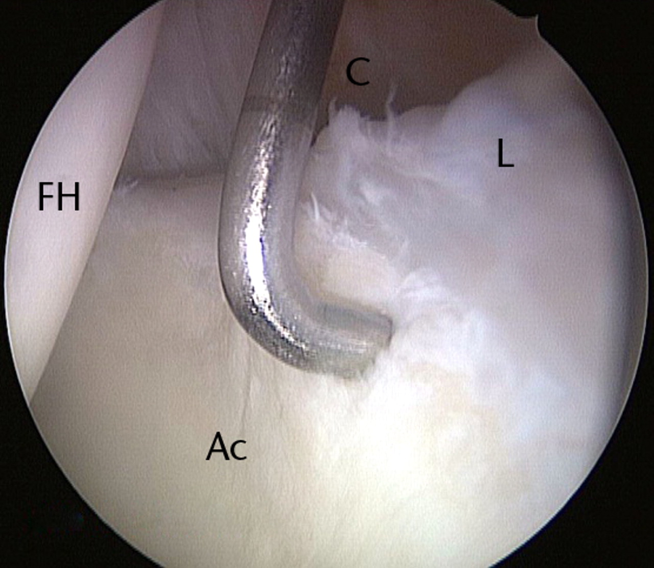 Figs. 9a - 9c 
          Arthroscopic images of the left
hip of a 36-year-old woman who had a previous hip arthroscopy three
years earlier, showing a) capsulolabral adhesions (arrow) in the
area of the perilabral sulcus corresponding to the previous surgical
intervention, in contrast to the normal capsule seen further anteriorly,
b) removal of the adhesions, and c) chondroplasty with labral repair
using a suture anchor. Symptoms improved as early as eight weeks post-operatively
(FH, femoral head; Ac, acetabulum; L, labrum; C, capsule).
        