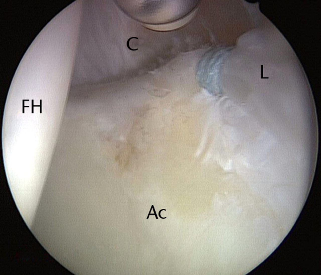 Figs. 9a - 9c 
          Arthroscopic images of the left
hip of a 36-year-old woman who had a previous hip arthroscopy three
years earlier, showing a) capsulolabral adhesions (arrow) in the
area of the perilabral sulcus corresponding to the previous surgical
intervention, in contrast to the normal capsule seen further anteriorly,
b) removal of the adhesions, and c) chondroplasty with labral repair
using a suture anchor. Symptoms improved as early as eight weeks post-operatively
(FH, femoral head; Ac, acetabulum; L, labrum; C, capsule).
        