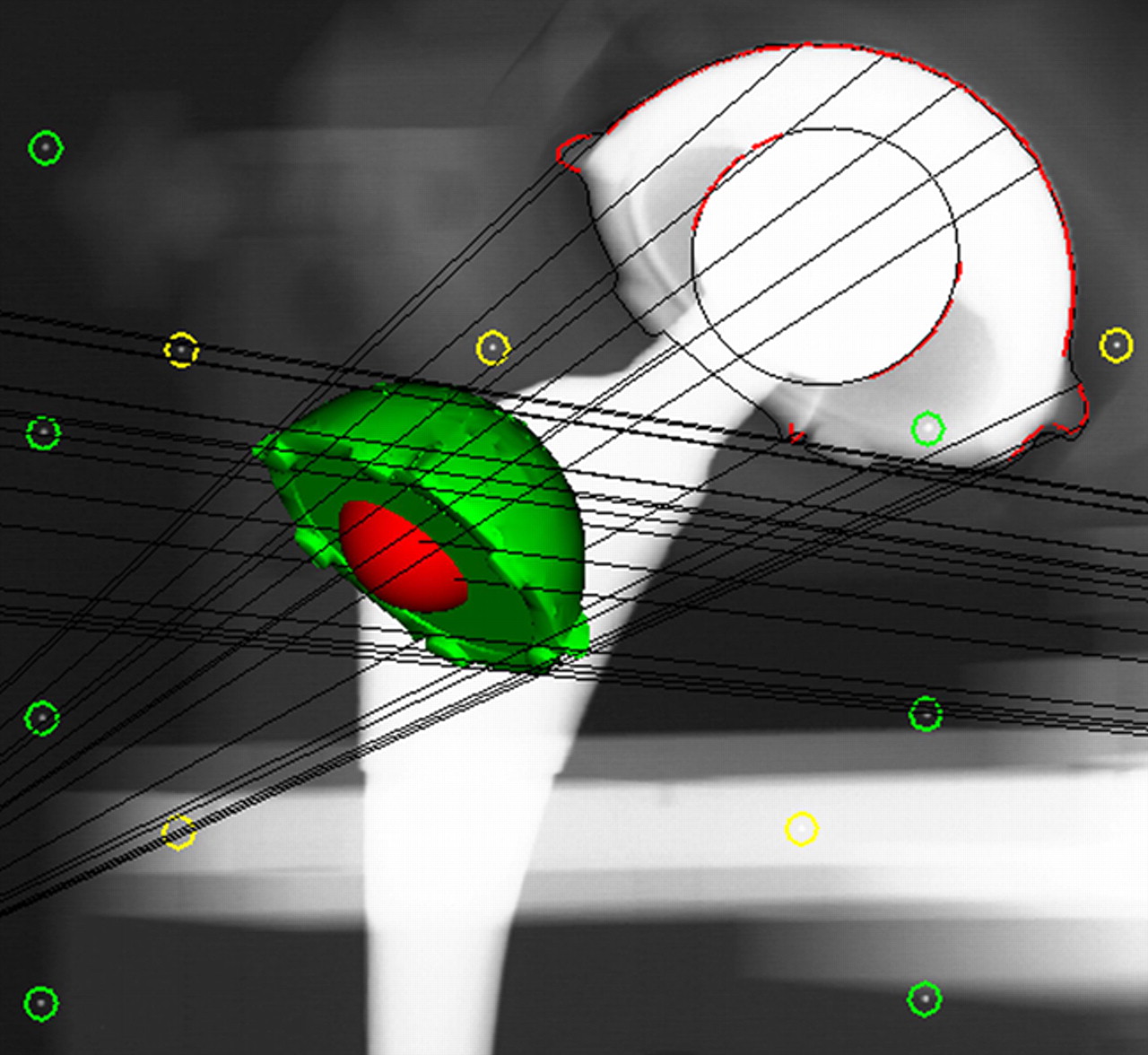 Figs. 3a - 3c 
            Graphic outputs for the assessment
of polyethylene wear, a) using model-based radiostereometric analysis
(MB-RSA), showing the scanned model of the acetabular component
(in green), b) geometrical sphere model RSA (EGS-RSA), showing the
regions of interest (in which the models are matched with mathematical
algorithms) marked with red lines on the peripheries of the acetabular
component and femoral head, and c) the PolyWare software, showing
ellipses fitted to the peripheries of the acetabular component and
femoral head shadows.
          