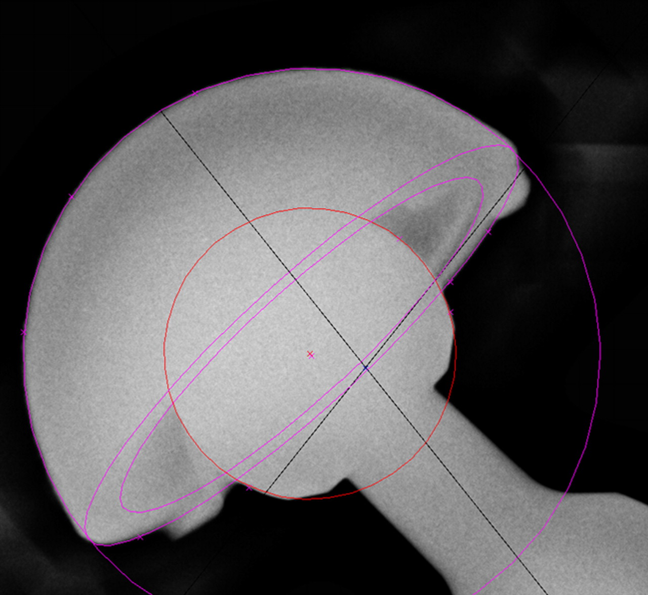 Figs. 3a - 3c 
            Graphic outputs for the assessment
of polyethylene wear, a) using model-based radiostereometric analysis
(MB-RSA), showing the scanned model of the acetabular component
(in green), b) geometrical sphere model RSA (EGS-RSA), showing the
regions of interest (in which the models are matched with mathematical
algorithms) marked with red lines on the peripheries of the acetabular
component and femoral head, and c) the PolyWare software, showing
ellipses fitted to the peripheries of the acetabular component and
femoral head shadows.
          