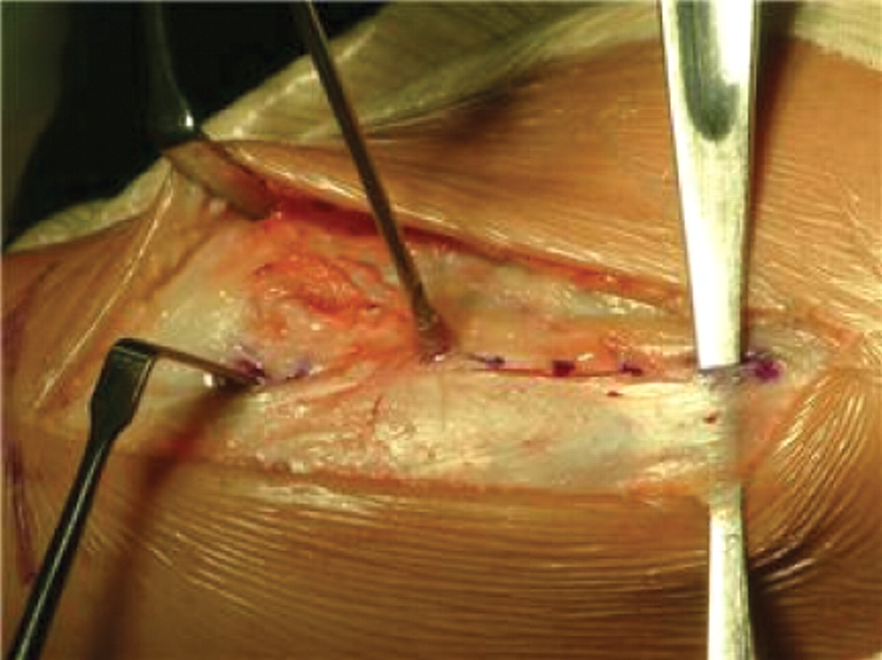 Figs. 3a - 3d 
            
              Figures 3a and 3b – intra-operative
photographs of the modified tibial tubercle osteotomy: a) drill
holes are made on either side of the tibial tubercle and a periosteal
bridge is maintained distally. The drill holes are then joined with
an osteotome angled to make the triangular osteotomy which is more
acute proximally than distally to improve the stability of the construct.
b) The osteotomy is anteriorised and held in place with two Kirschner
wires before being held definitively with two 3.5 mm self-tapping cortical
screws to allow compression. Figures 3c and 3d – diagrams representing
the position of the osteotomy, showing c) that the angle of the
cut is more acute proximally than distally, and showing d) the position
in which the osteotomy is fixed, with the acute angle of the medial
limb of the osteotomy meaning that little medialisation occurs for
the degree of anteriorisation.
          