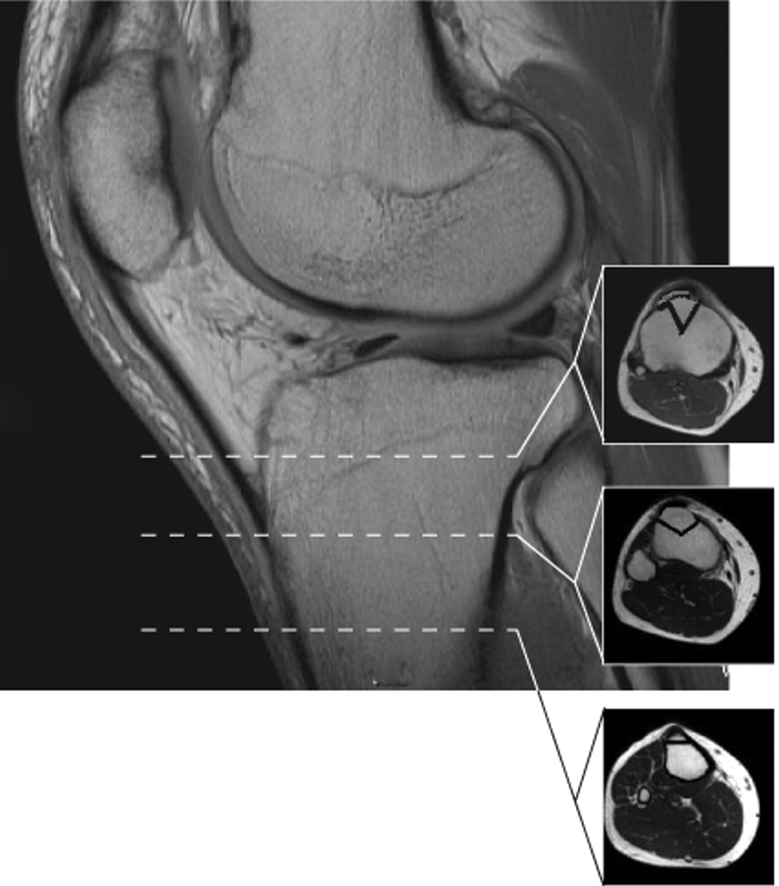 Figs. 3a - 3d 
            
              Figures 3a and 3b – intra-operative
photographs of the modified tibial tubercle osteotomy: a) drill
holes are made on either side of the tibial tubercle and a periosteal
bridge is maintained distally. The drill holes are then joined with
an osteotome angled to make the triangular osteotomy which is more
acute proximally than distally to improve the stability of the construct.
b) The osteotomy is anteriorised and held in place with two Kirschner
wires before being held definitively with two 3.5 mm self-tapping cortical
screws to allow compression. Figures 3c and 3d – diagrams representing
the position of the osteotomy, showing c) that the angle of the
cut is more acute proximally than distally, and showing d) the position
in which the osteotomy is fixed, with the acute angle of the medial
limb of the osteotomy meaning that little medialisation occurs for
the degree of anteriorisation.
          