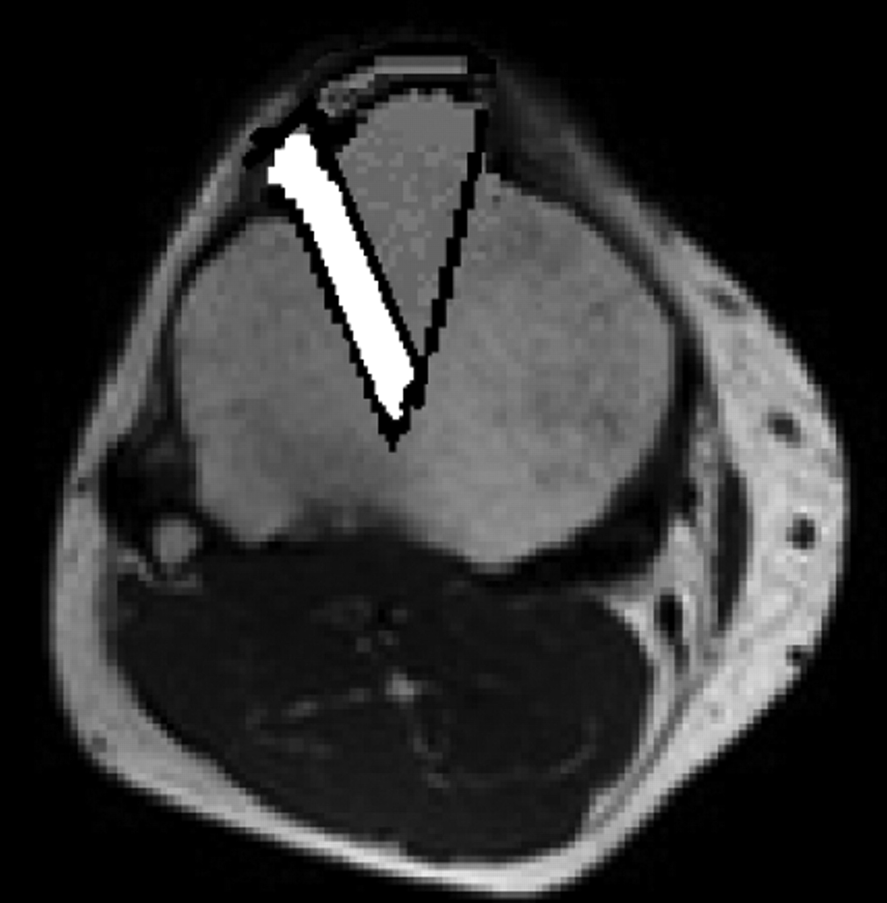 Figs. 3a - 3d 
            
              Figures 3a and 3b – intra-operative
photographs of the modified tibial tubercle osteotomy: a) drill
holes are made on either side of the tibial tubercle and a periosteal
bridge is maintained distally. The drill holes are then joined with
an osteotome angled to make the triangular osteotomy which is more
acute proximally than distally to improve the stability of the construct.
b) The osteotomy is anteriorised and held in place with two Kirschner
wires before being held definitively with two 3.5 mm self-tapping cortical
screws to allow compression. Figures 3c and 3d – diagrams representing
the position of the osteotomy, showing c) that the angle of the
cut is more acute proximally than distally, and showing d) the position
in which the osteotomy is fixed, with the acute angle of the medial
limb of the osteotomy meaning that little medialisation occurs for
the degree of anteriorisation.
          