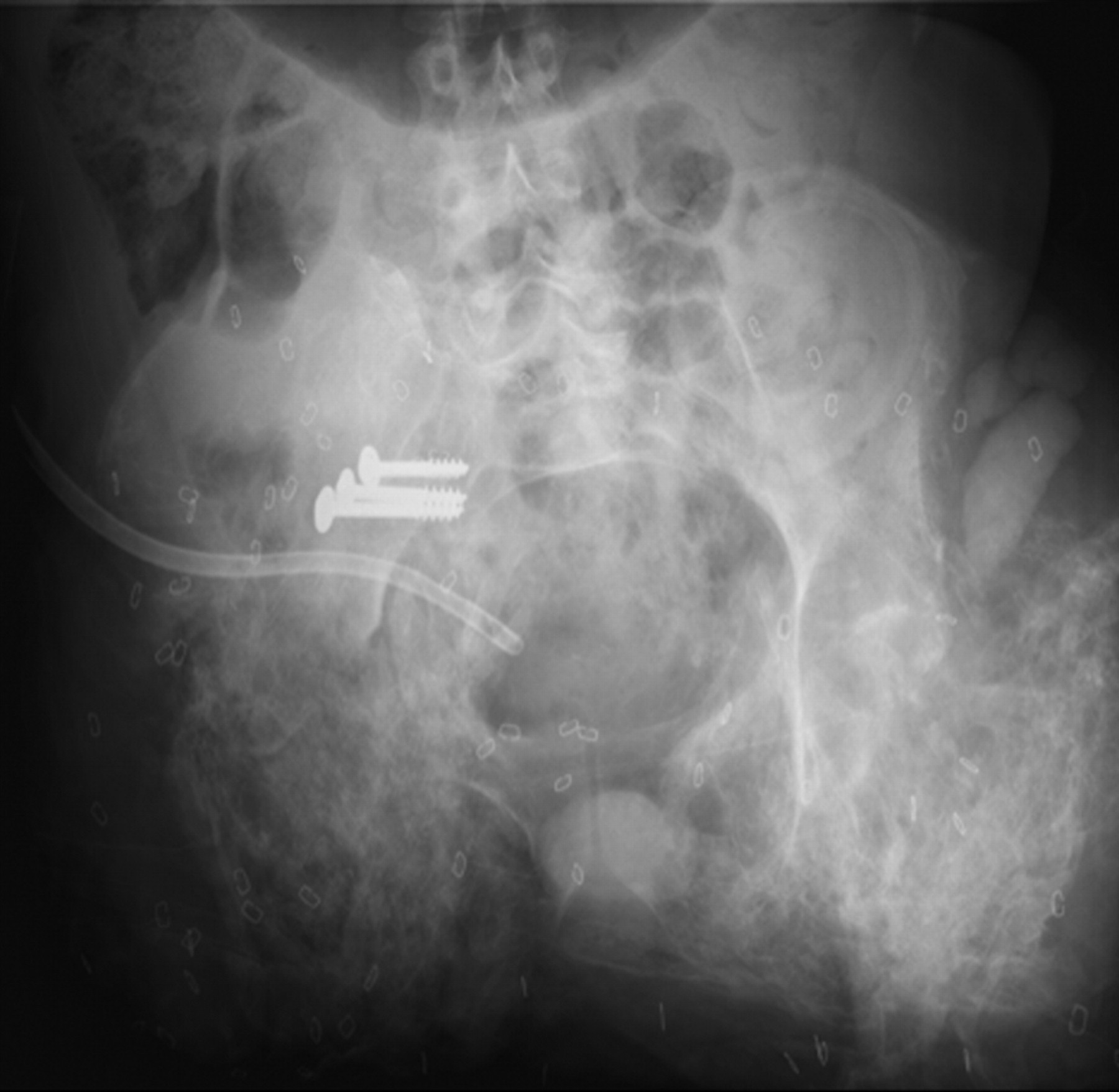 Figs. 1a - 1b 
          Radiograph (a) and three-dimensional
CT rendering (b) of a patient with severe pelvic heterotopic ossification
after bilateral hip disarticulations due to combat-related blast
injuries.
        