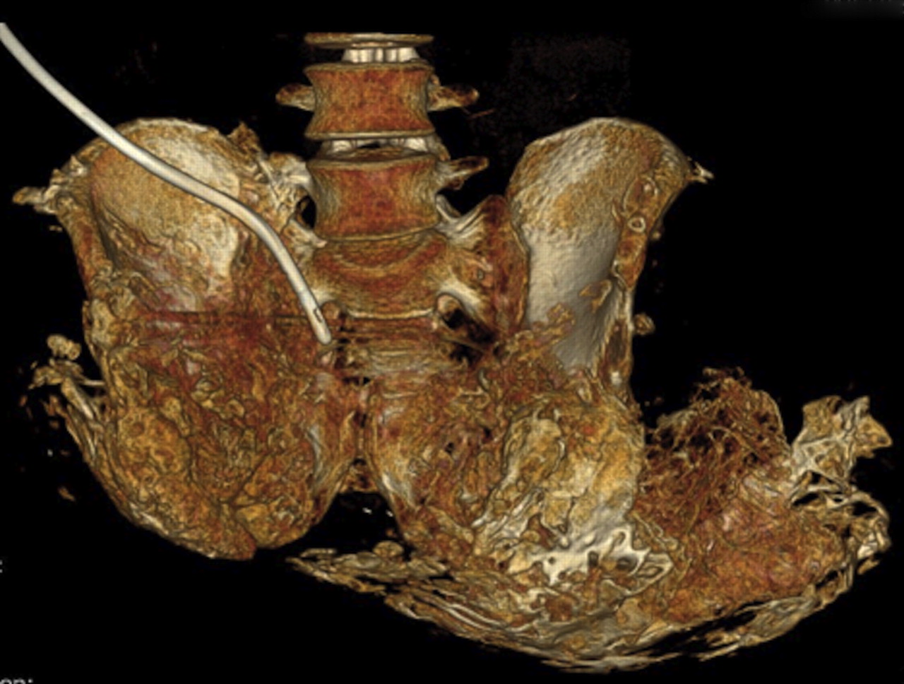 Figs. 1a - 1b 
          Radiograph (a) and three-dimensional
CT rendering (b) of a patient with severe pelvic heterotopic ossification
after bilateral hip disarticulations due to combat-related blast
injuries.
        