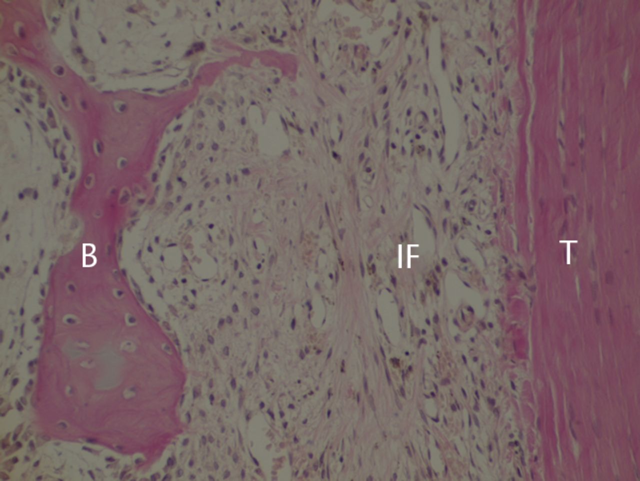 Figs. 2a - 2c 
            Histological images at two weeks
post-operatively with a) elastic van Gieson staining, b) immunostaining
for type I collagen, and c) immunostaining for type III collagen
(B, bone; IF, interface; T, tendon graft; all original magnifications
× 200).
          