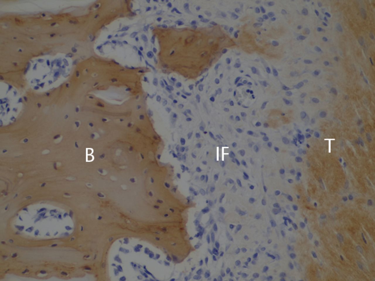 Figs. 2a - 2c 
            Histological images at two weeks
post-operatively with a) elastic van Gieson staining, b) immunostaining
for type I collagen, and c) immunostaining for type III collagen
(B, bone; IF, interface; T, tendon graft; all original magnifications
× 200).
          