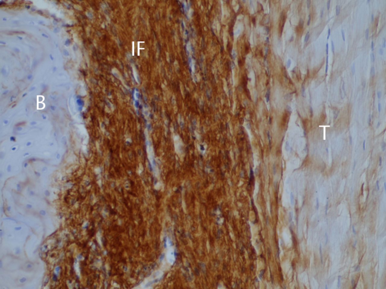 Figs. 2a - 2c 
            Histological images at two weeks
post-operatively with a) elastic van Gieson staining, b) immunostaining
for type I collagen, and c) immunostaining for type III collagen
(B, bone; IF, interface; T, tendon graft; all original magnifications
× 200).
          