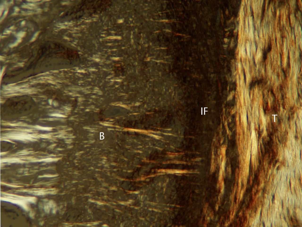 Fig. 3 
            Photograph of polarised light microscopy
at four weeks post-operatively (T, tendon graft; IF, interface;
B, bone; original magnification × 100).
          