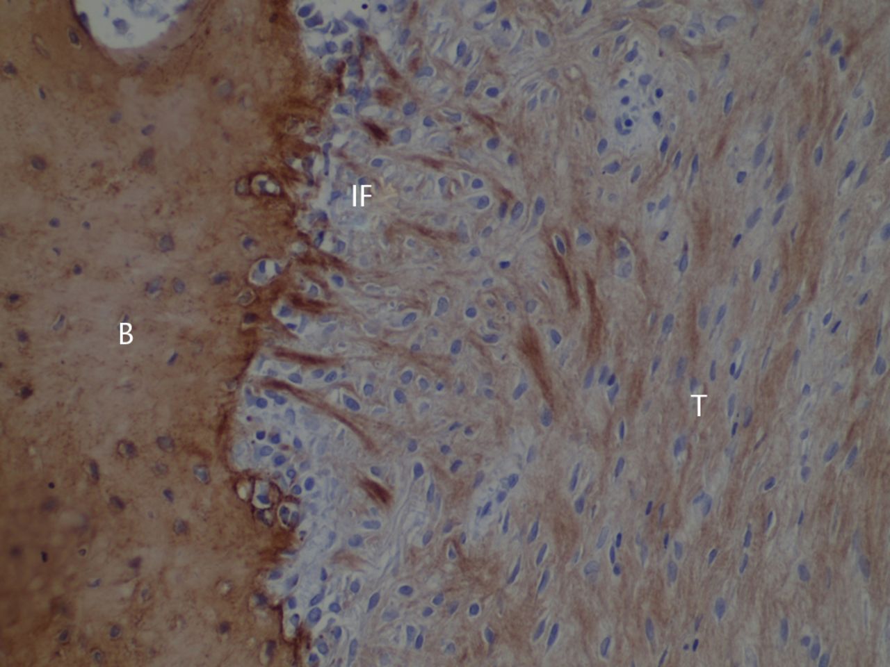 Fig. 5 
            Histological images at 12 weeks post-operatively
with immunostaining for type I collagen (T; tendon graft; IF, interface;
B, bone; original magnification × 200).
          