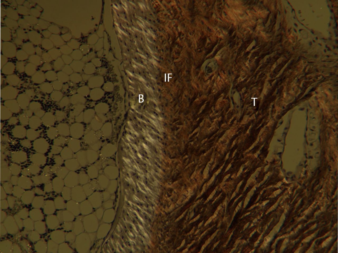 Fig. 7 
            Photograph of polarised light microscopy
at 26 weeks post-operatively (T, tendon graft; IF, interface; B,
bone; original magnification × 100).
          