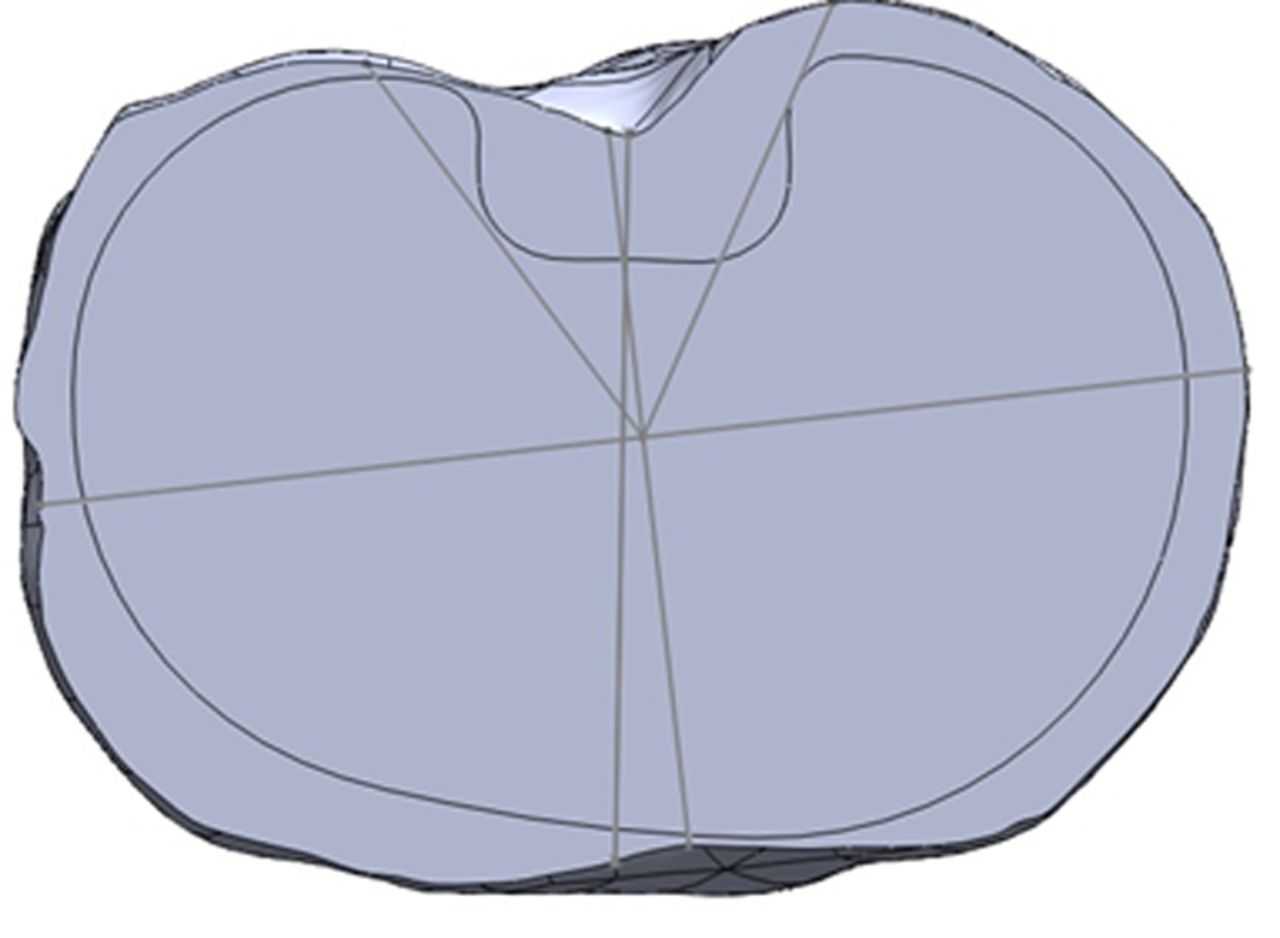 Figs. 4a - 4b 
            Diagrams showing the tibia template,
with a) the asymmetric prosthesis aligned with the surgical axis,
with no overhang permitted, and b) the symmetric prosthesis aligned
with the surgical axis, with minimal posterolateral overhang permitted
(*).
          