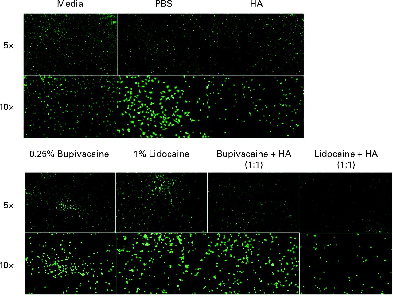 Fig. 2 
            Representative LIVE staining at 5× and
10× magnification of chondrocytes treated with each condition, stained
using 4 mM Calcien AM and visualised using fluorescence microscopy
under a fluorescein isothiocyanate (FITC) filter. Chondrocytes co-treated with
bupivacaine and hyaluronic acid (HA) showed improved density when
compared with bupivacaine-only treated chondrocytes. There was no
noticeable increase in cell density between cells treated with lidocaine
and cells co-treated with lidocaine and HA (PBS, phosphate buffered
saline).
          