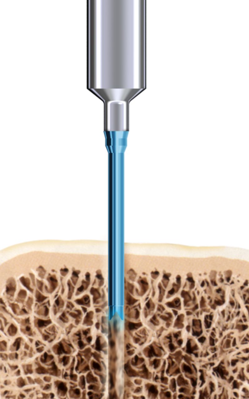 Figs. 1a - 1c 
            Diagrams showing the use
of the SonicPin system (Stryker GmbH), a) at implantation, mounted
on the ultrasound applicator, b) after ultrasound and removal of
the applicator, and c) showing the ‘melting’ of the pin into the
cancellous bone.
          