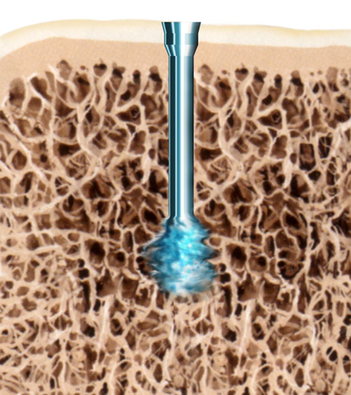 Figs. 1a - 1c 
            Diagrams showing the use
of the SonicPin system (Stryker GmbH), a) at implantation, mounted
on the ultrasound applicator, b) after ultrasound and removal of
the applicator, and c) showing the ‘melting’ of the pin into the
cancellous bone.
          