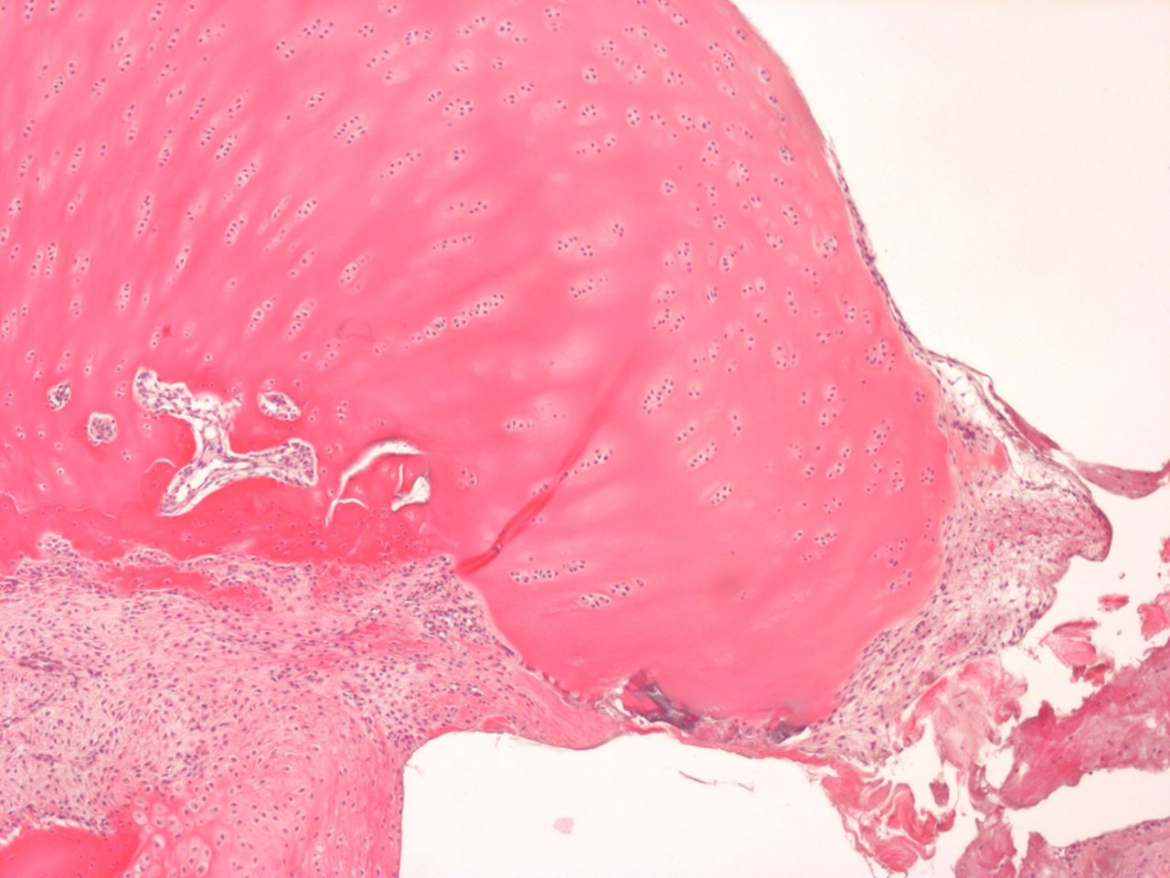 Figs. 4a - 4b 
            Histological images of cartilage
after removal of the SonicPin system (Stryker GmbH), a) at × 25
magnification, showing the cartilage surface without major damage
after removing the SonicPin, and b) at × 40 magnification, showing
the cartilage next to the removed SonicPin.
          