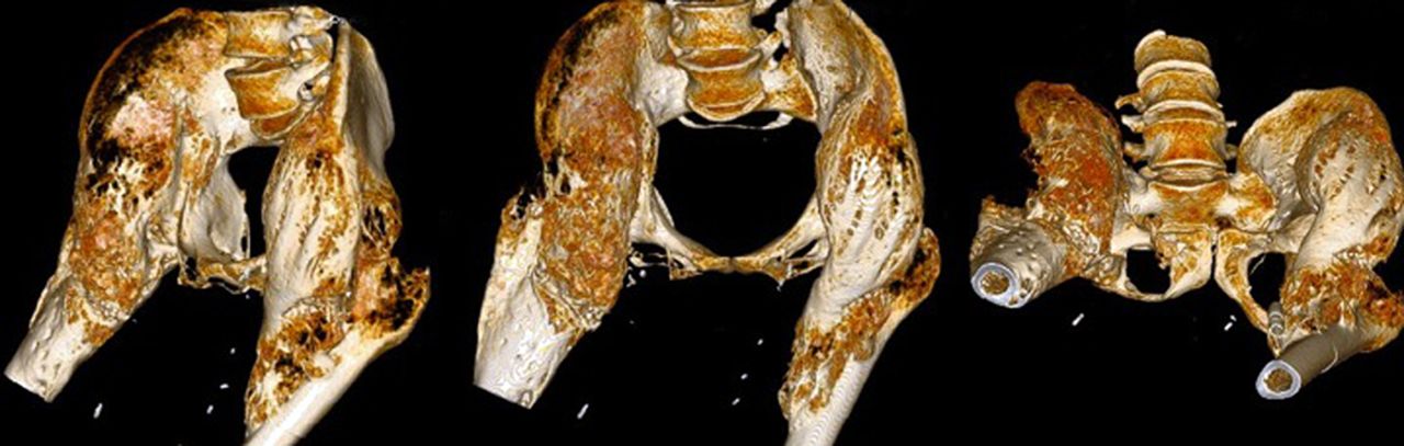 Fig. 2 
          A 40-year-old male patient sustained
an American Spinal Injury Association (ASIA) grade-A spinal cord
injury from a gunshot at the level of T10. At five years after injury,
three-dimensional CT images show massive bilateral heterotopic ossification
(HO) of the hips with joint ankylosis. Complications of the extensive
HO include recalcitrant sacral pressure ulcers and an inability
to sit in a wheelchair.
        