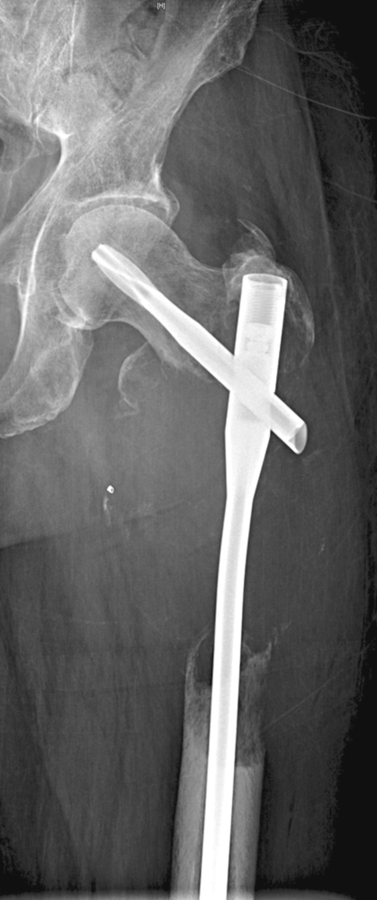 Figs. 1a - 1c 
          Case 1. Figure 1a – anteroposterior
(AP) radiograph upon presentation to the specialist orthopaedic
oncology unit, showing distal progression of the disease and impending
fracture of the implant. Figure 1b – angiogram showing selective
embolisation of the proximal metastatic deposit. Figure 1c – post-operative
AP radiograph taken three days after total femoral replacement.
        