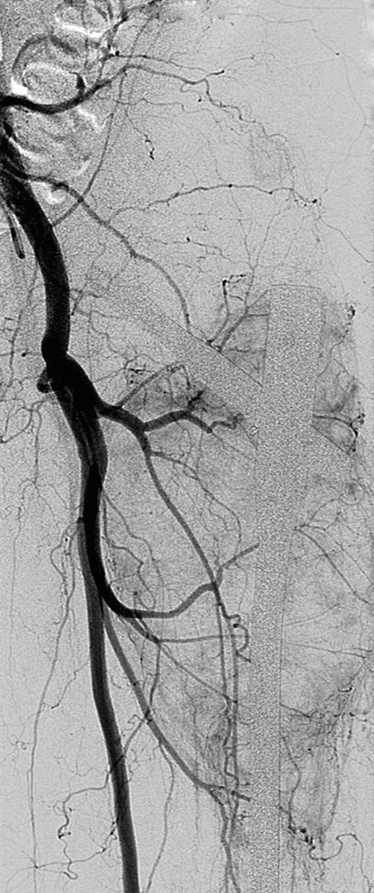 Figs. 1a - 1c 
          Case 1. Figure 1a – anteroposterior
(AP) radiograph upon presentation to the specialist orthopaedic
oncology unit, showing distal progression of the disease and impending
fracture of the implant. Figure 1b – angiogram showing selective
embolisation of the proximal metastatic deposit. Figure 1c – post-operative
AP radiograph taken three days after total femoral replacement.
        