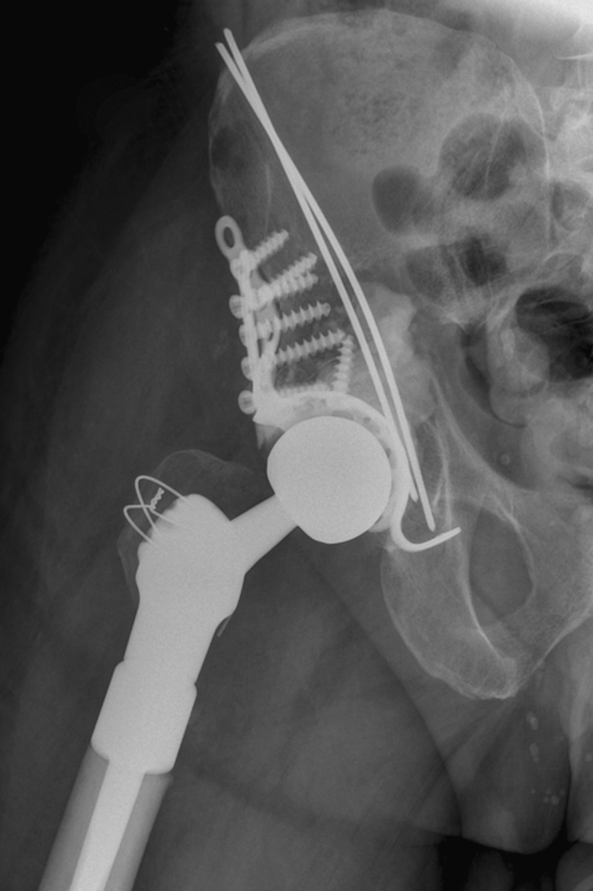 Figs. 2a - 2b 
          Case 2. Radiographs a) on presentation,
showing a pathological fracture of the right acetabulum and a lytic
lesion of the ipsilateral proximal femur, and b) at three days after
proximal femoral replacement and acetabular reconstruction using
a Graft Augmentation Prosthesis and the Harrington pin technique.
        