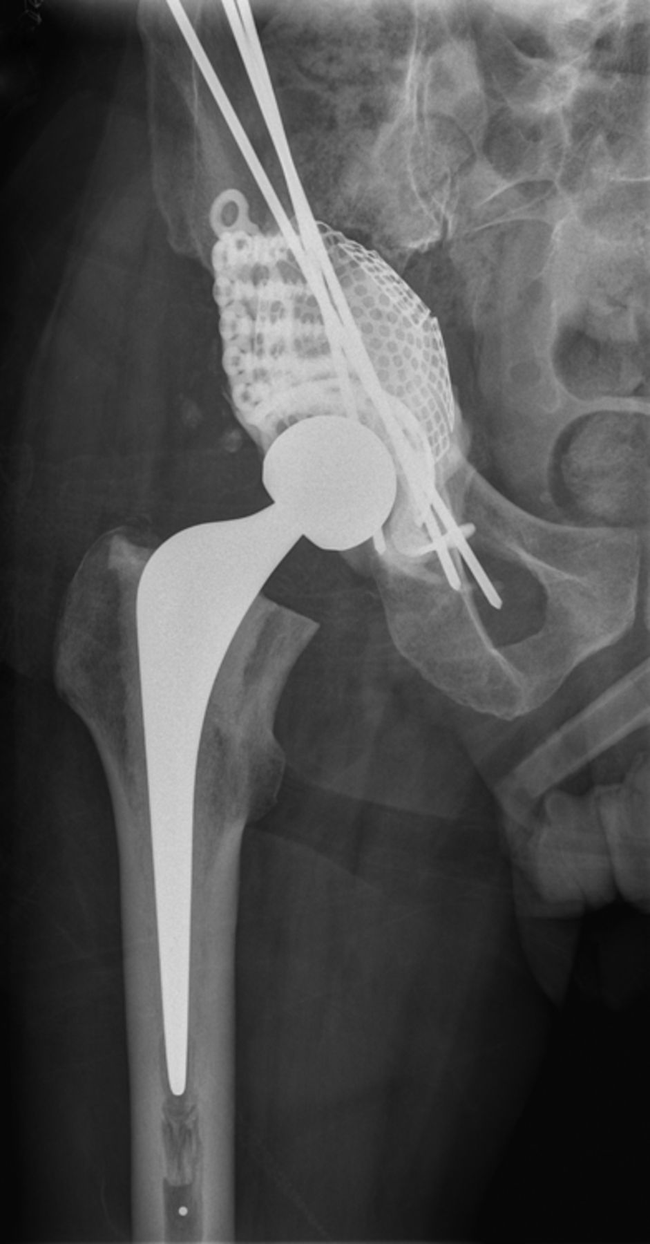 Figs. 3a - 3b 
          Case 3. Radiographs a) on presentation
to the specialist orthopaedic oncology unit, showing medial migration
of the cementoma, and b) at two days after acetabular reconstruction
using a Graft Augmentation Prosthesis, mesh and the Harrington pin technique.
        